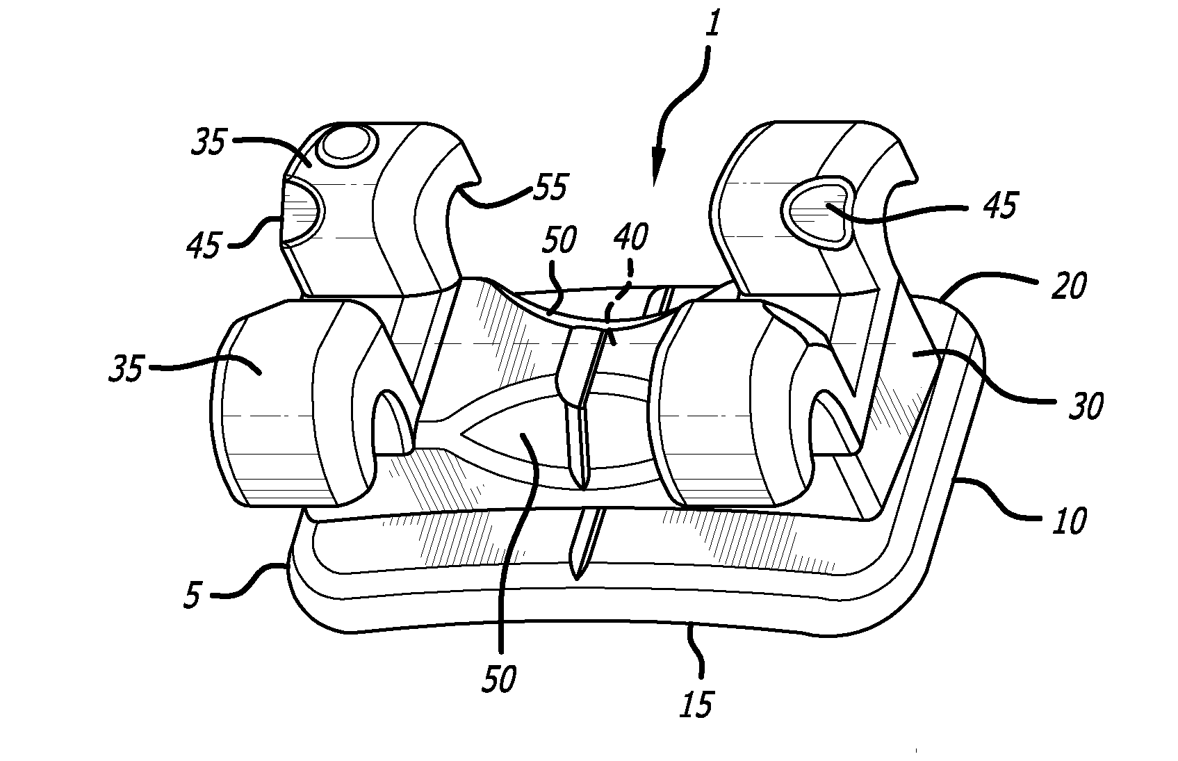 Orthodontic bracket system