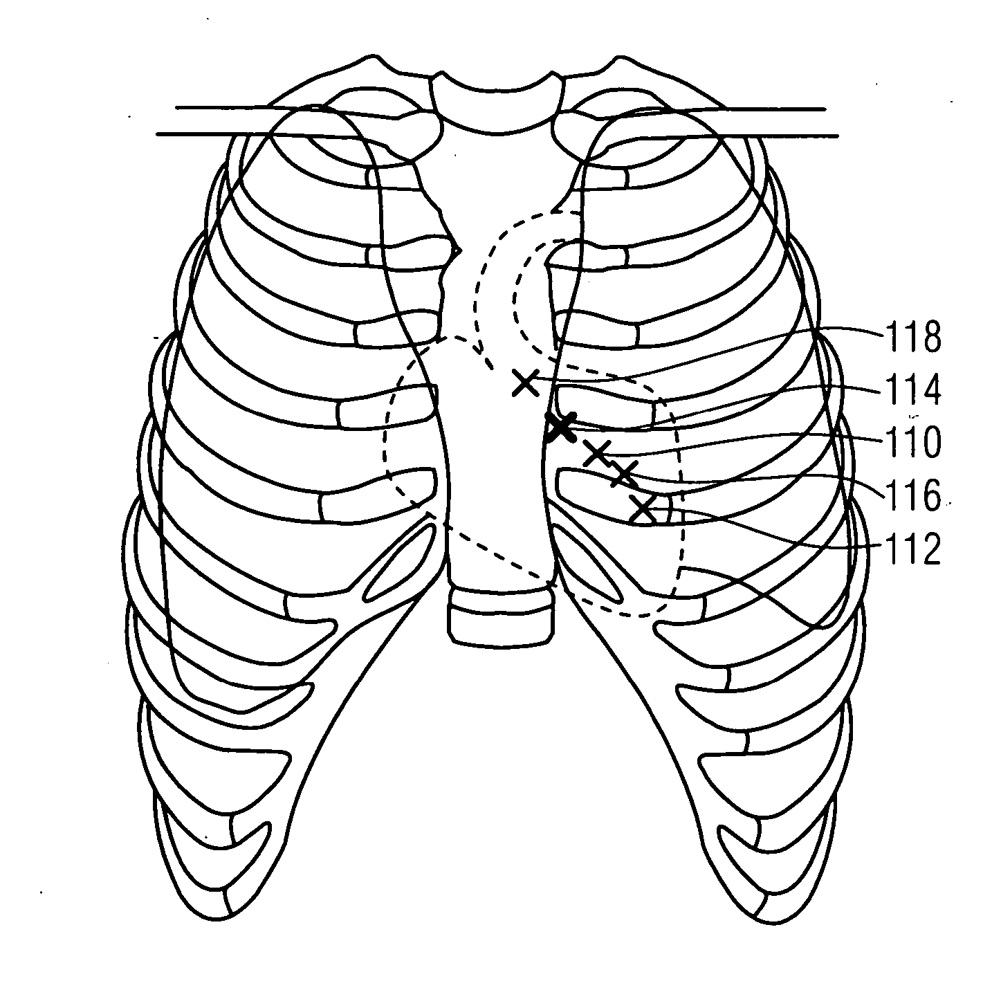 Method for providing measuring data for the precise local positioning of a catheter