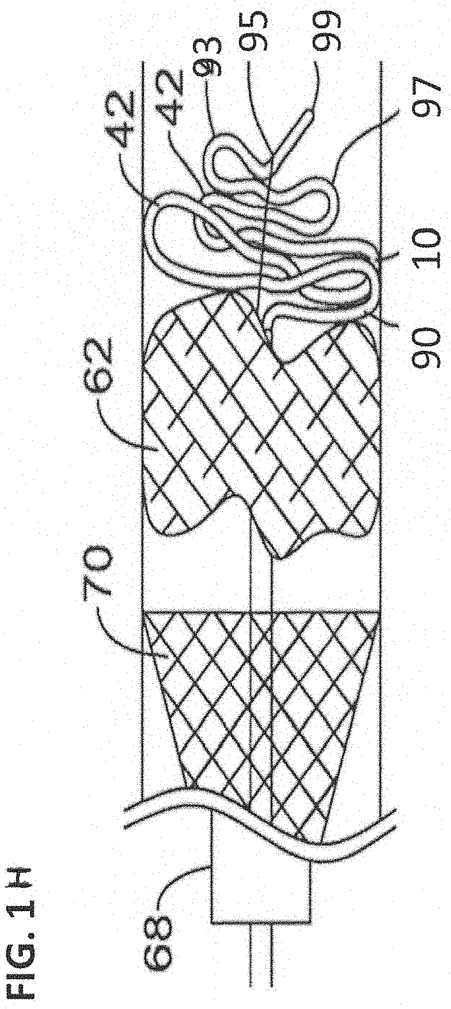 Device and method for treatment of deep vein   thrombosis and pulmonary embolism