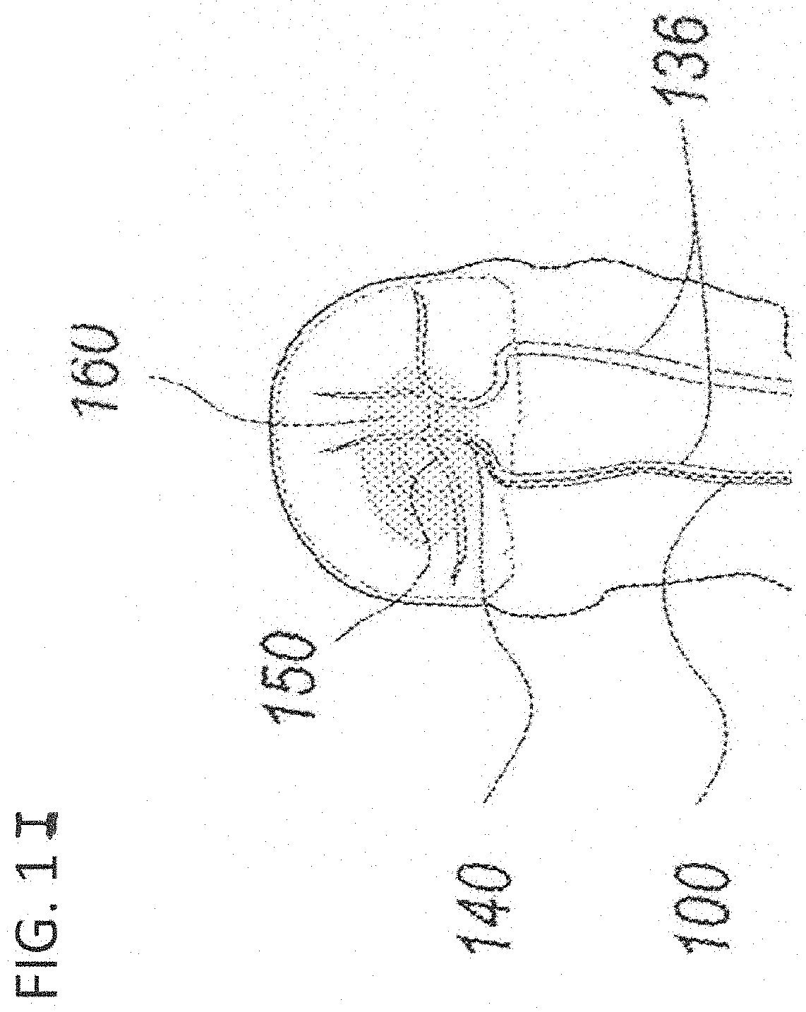 Device and method for treatment of deep vein   thrombosis and pulmonary embolism