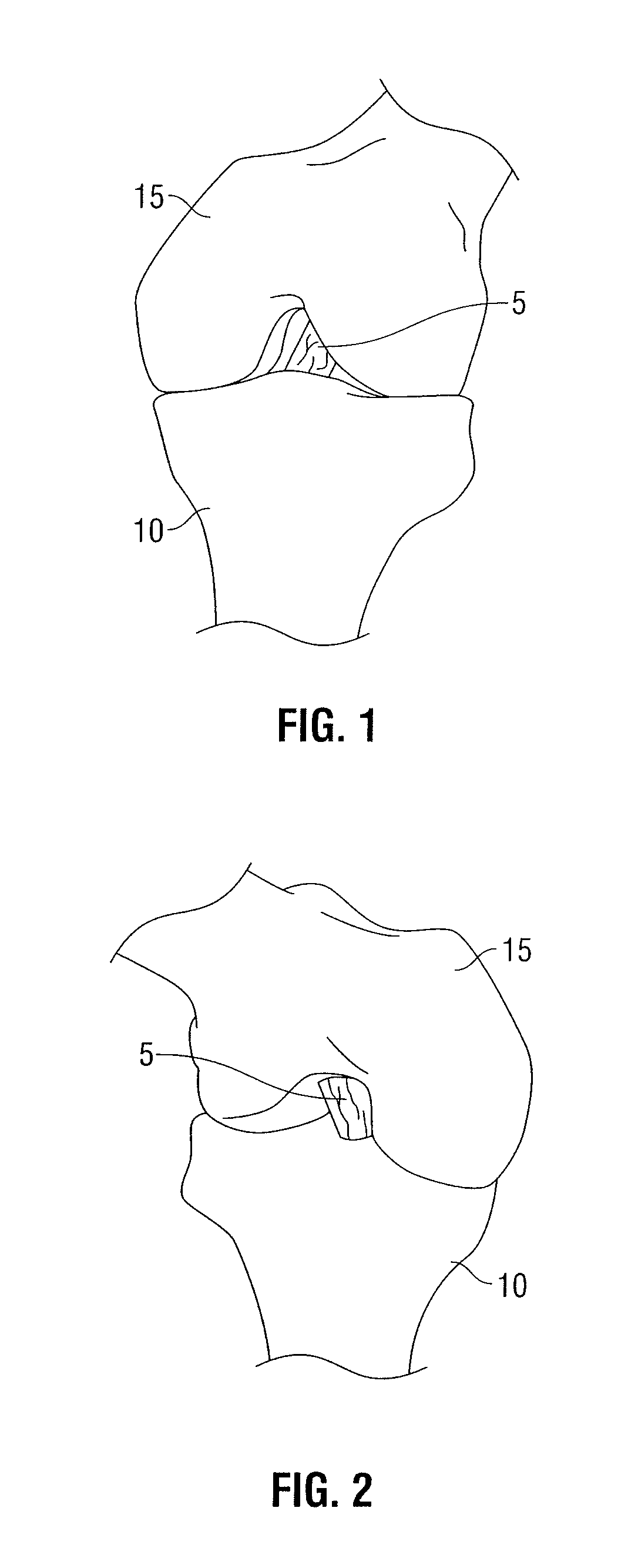 Tibial guide for acl repair having left/right docking configuration