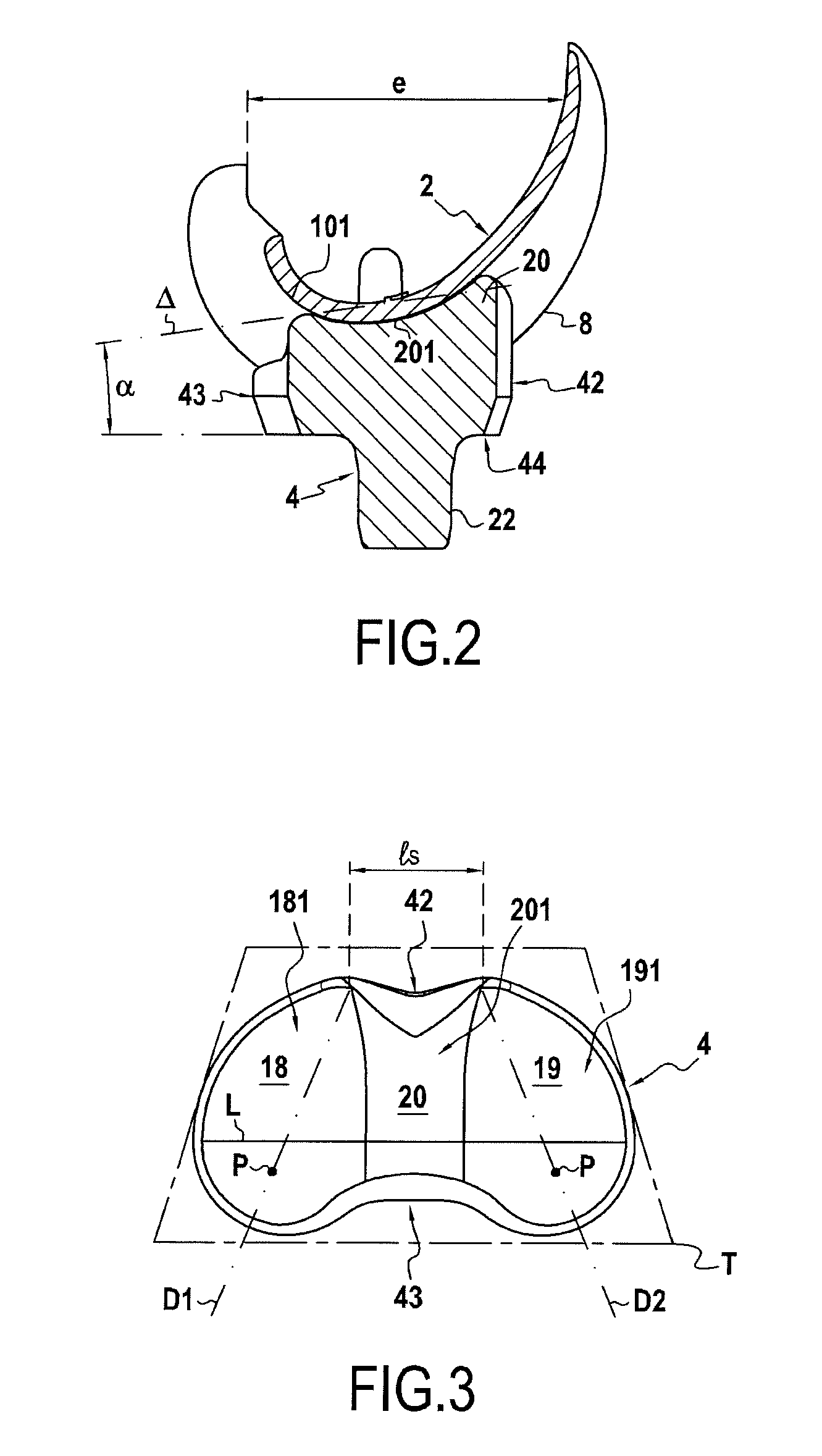 Total knee prosthesis