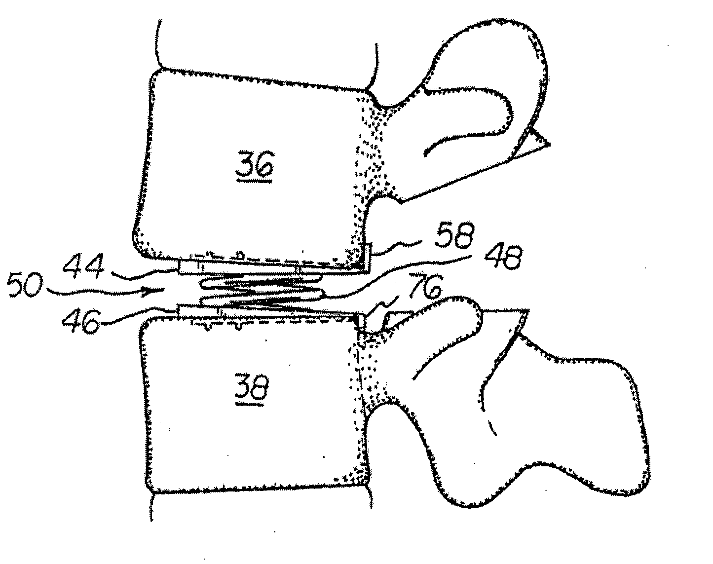 Vertebral implants adapted for posterior insertion