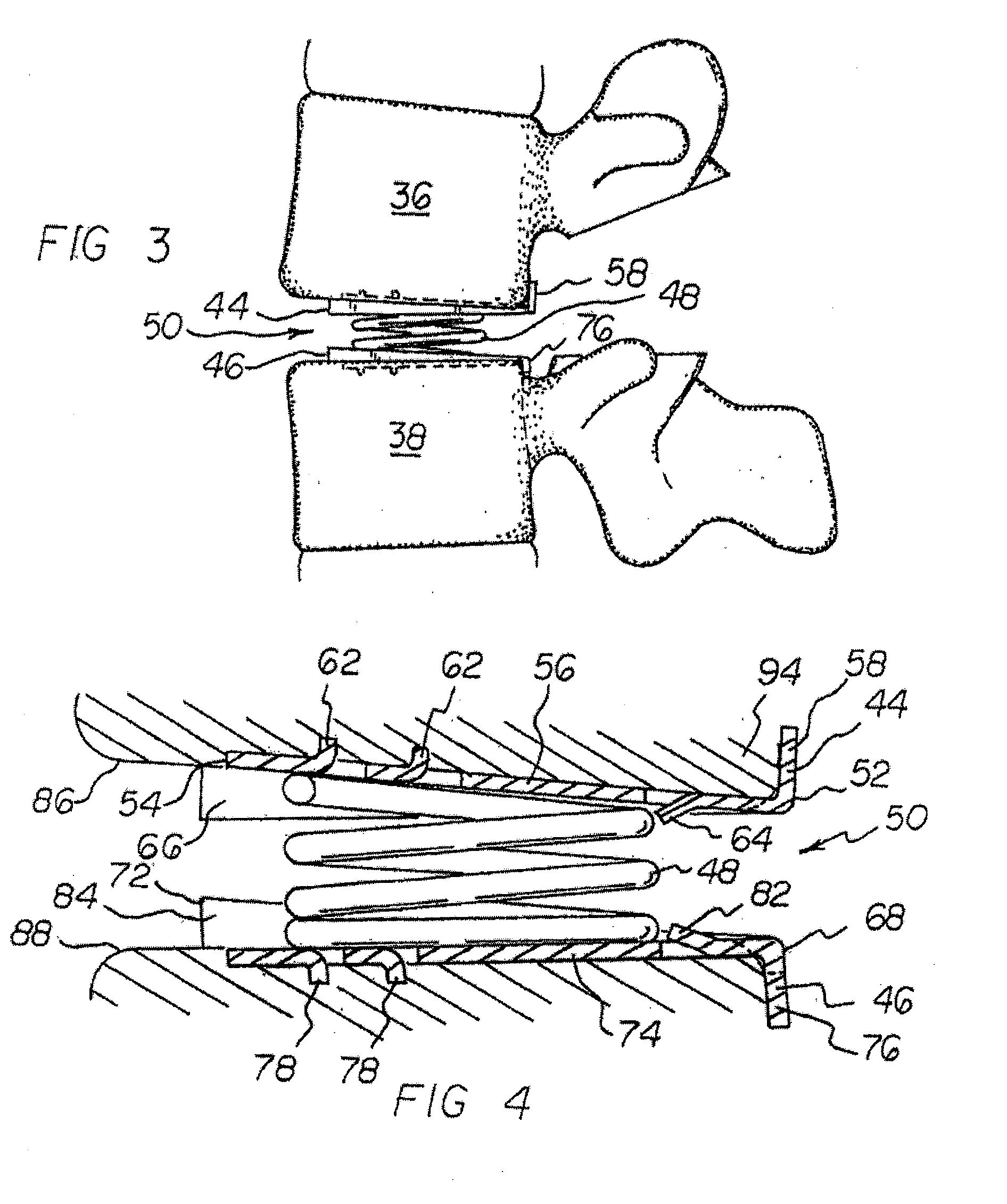 Vertebral implants adapted for posterior insertion