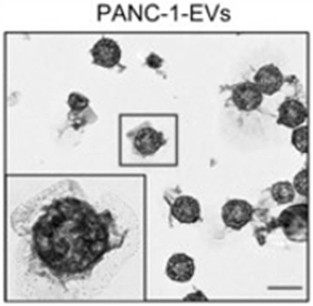 Application of hnRNPA1 in diagnosis, prognosis and treatment of pancreatic cancer