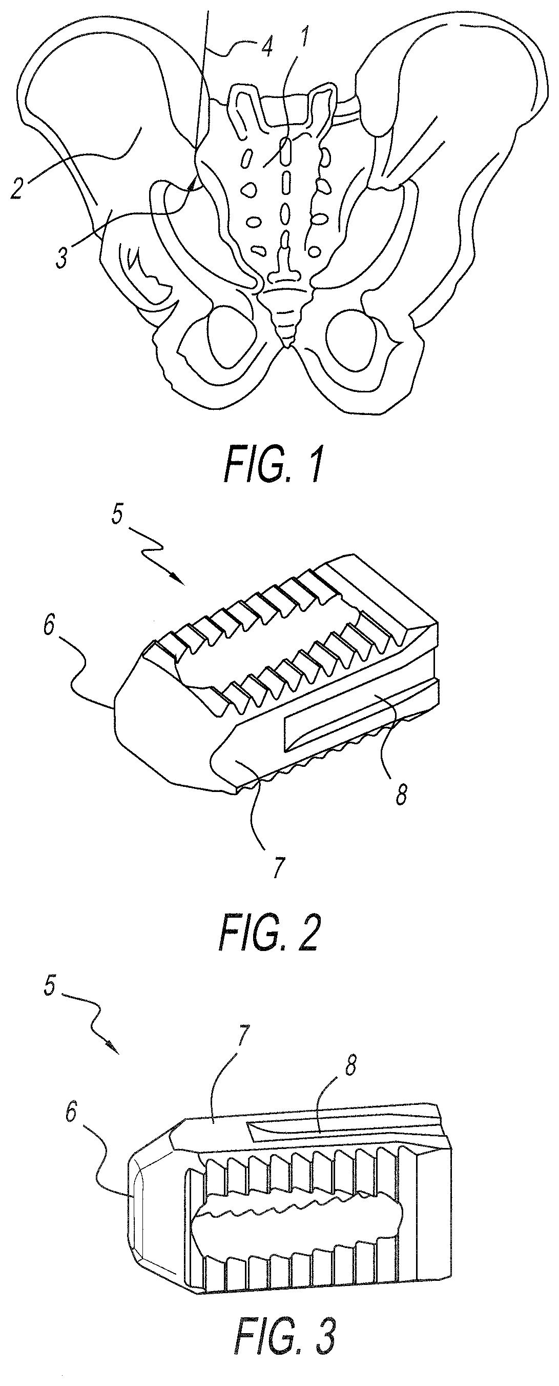 Allograft implant for fusing a sacroiliac joint