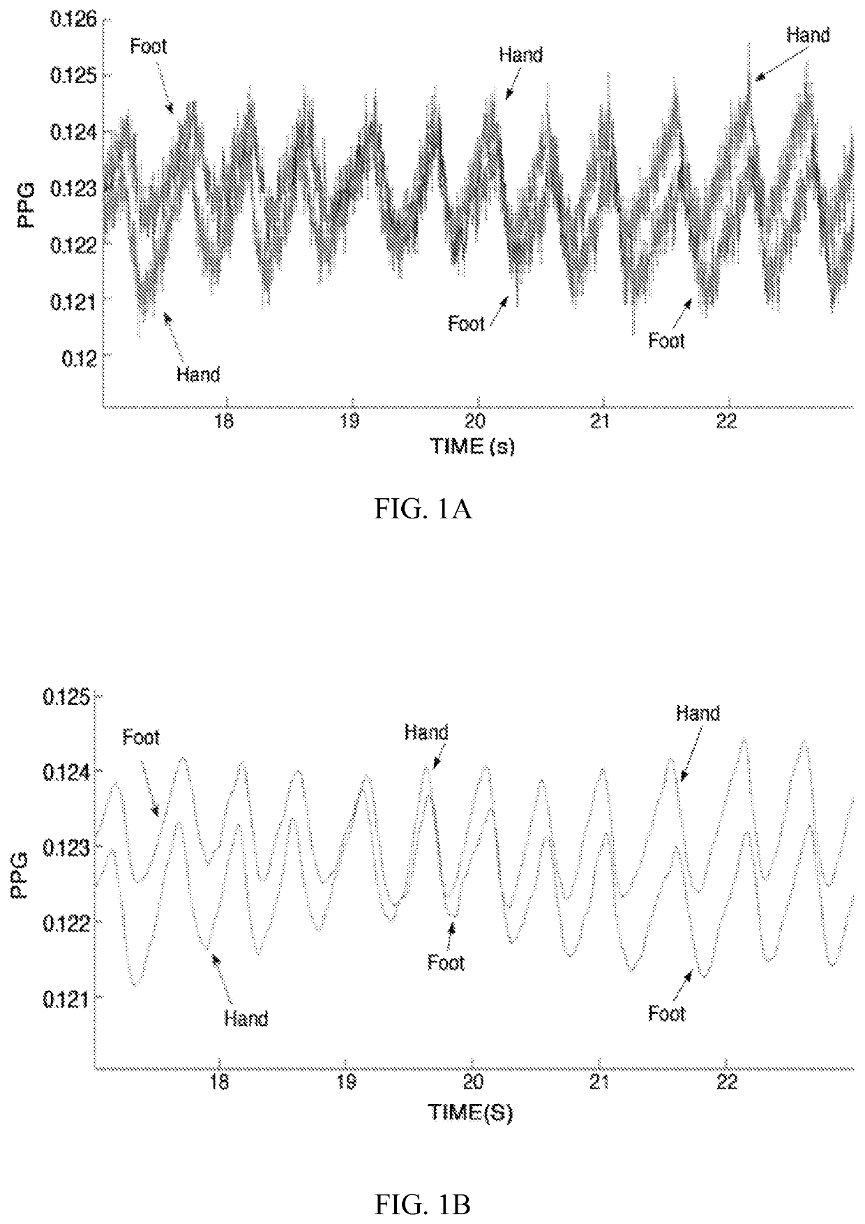 Detection of patent ductus arteriosus using photoplethysmography