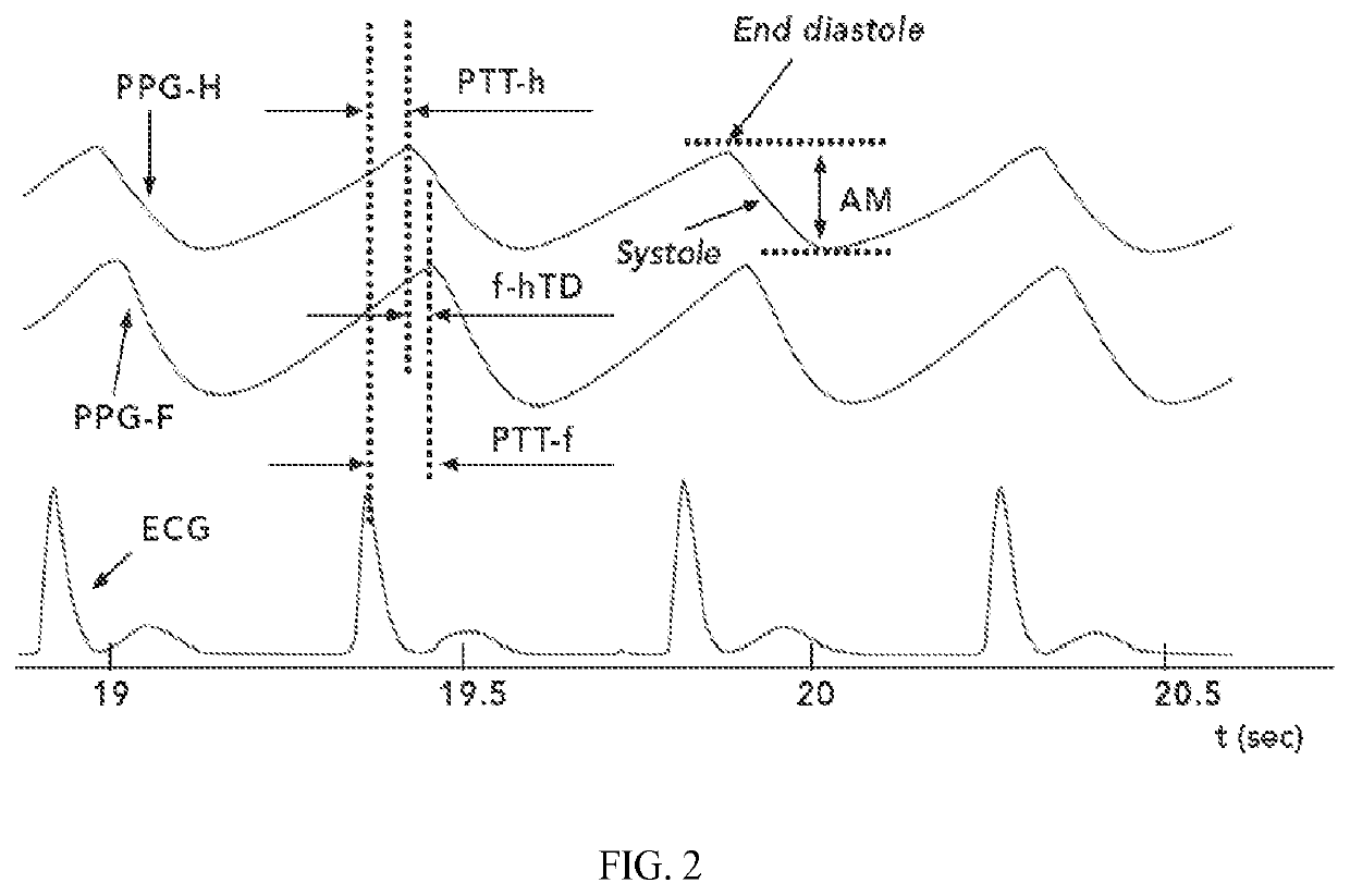 Detection of patent ductus arteriosus using photoplethysmography