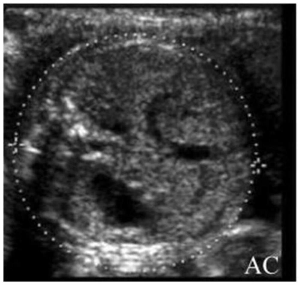 Method for predicting birth weight of full-term newborn at 21-23 weeks of pregnancy