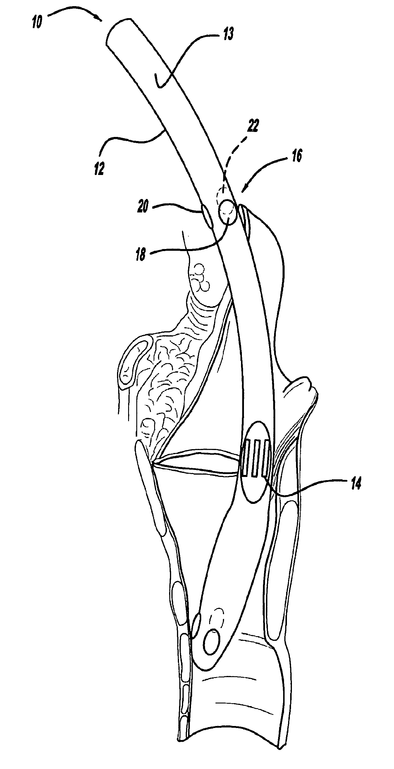 Nerve monitoring device