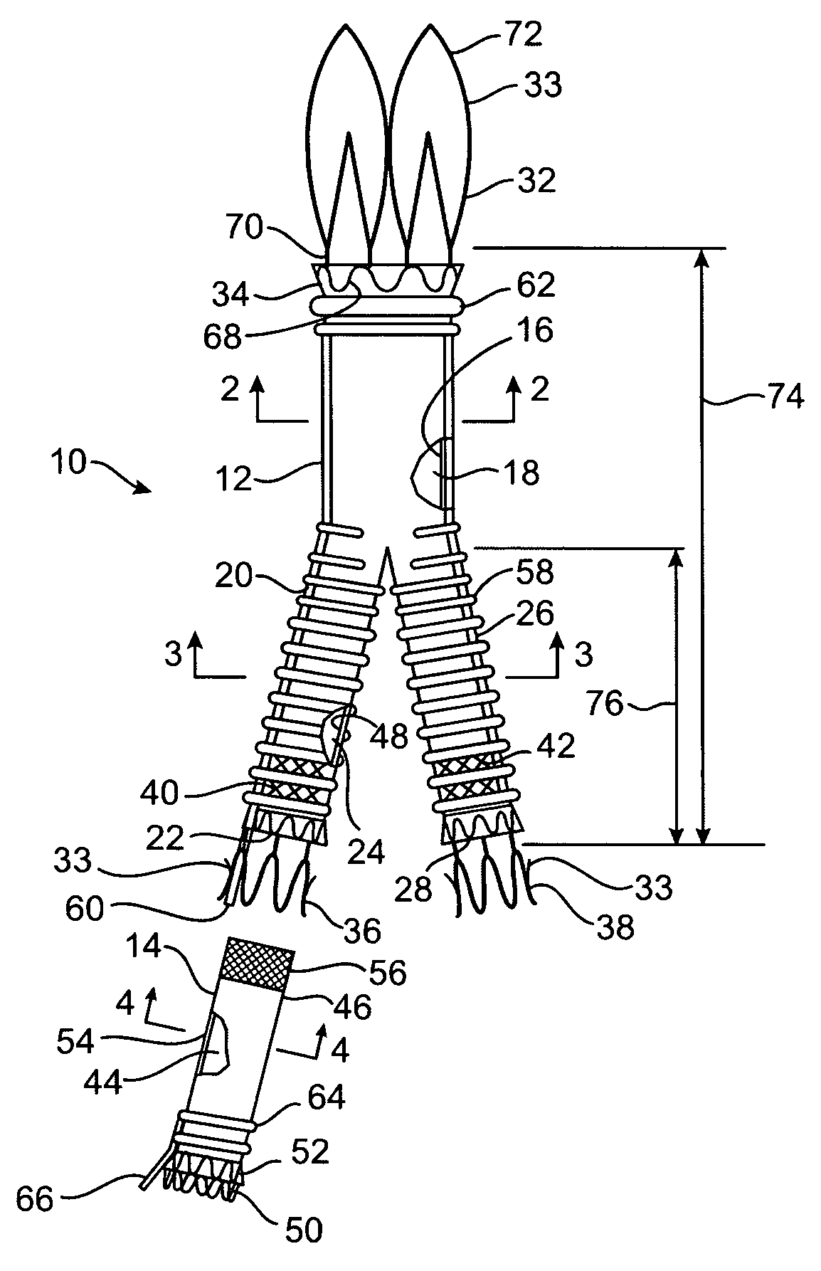 Hybrid modular endovascular graft