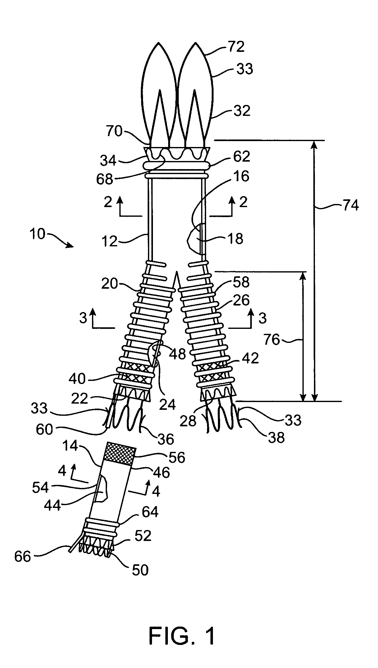 Hybrid modular endovascular graft