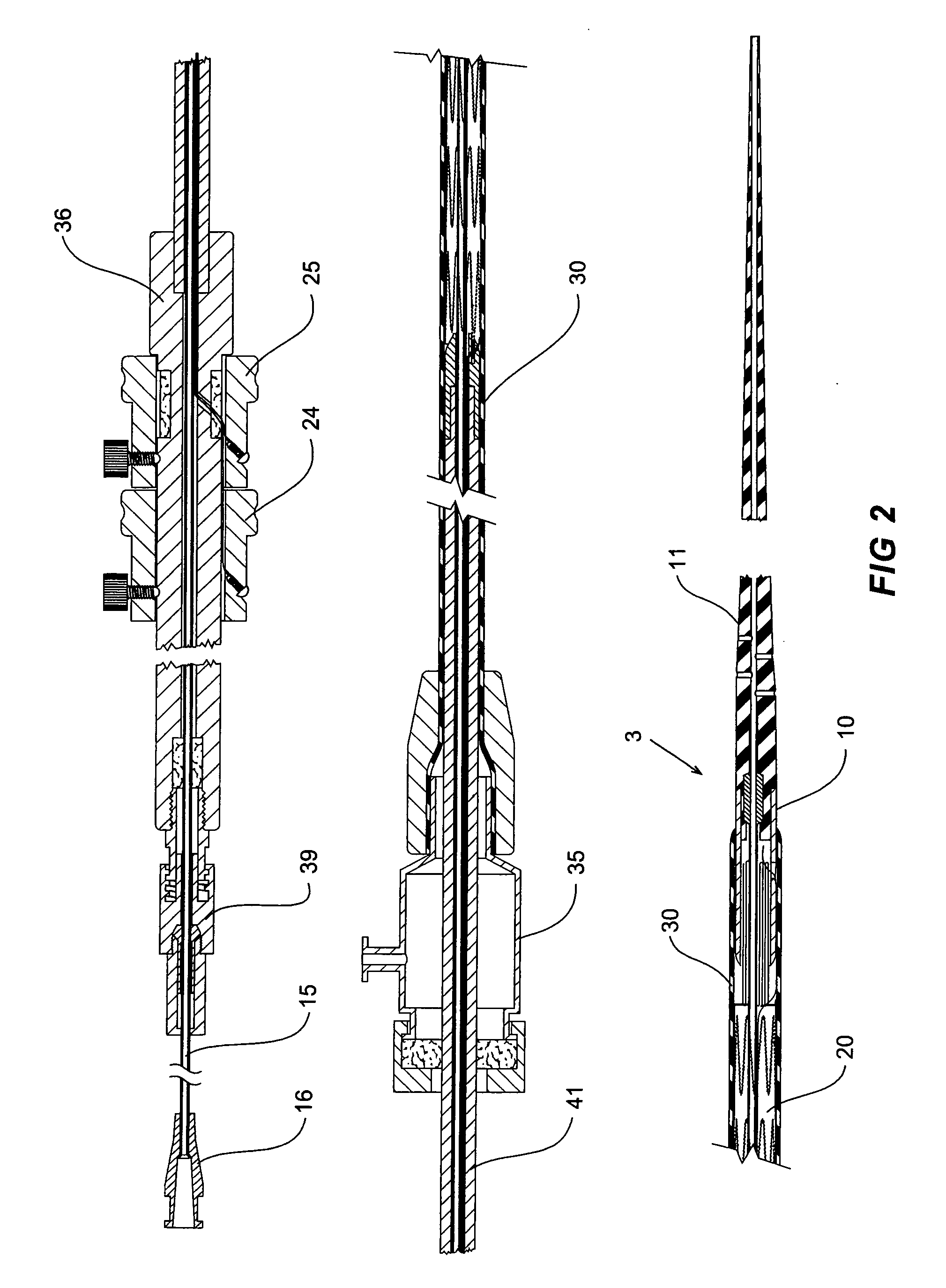 Prosthesis and a method and means of deploying a prosthesis