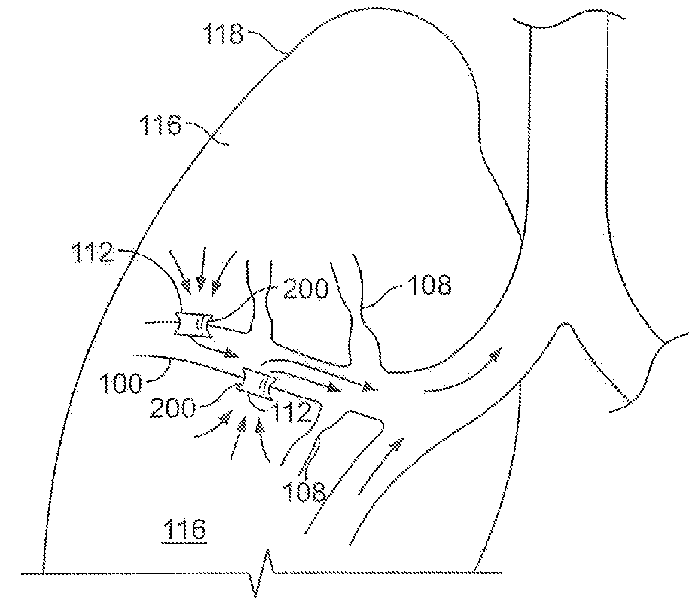 Airway bypass site selection and treatment planning