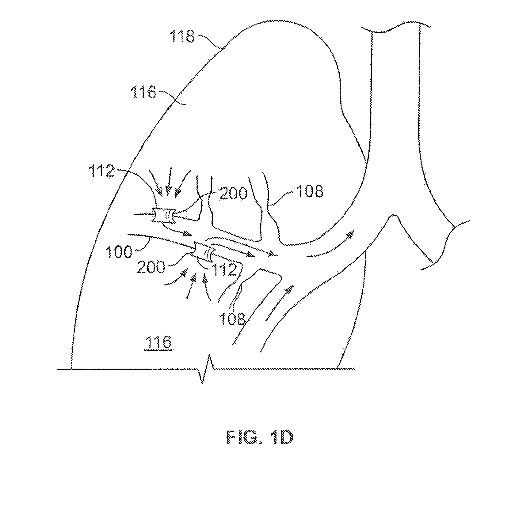 Airway bypass site selection and treatment planning