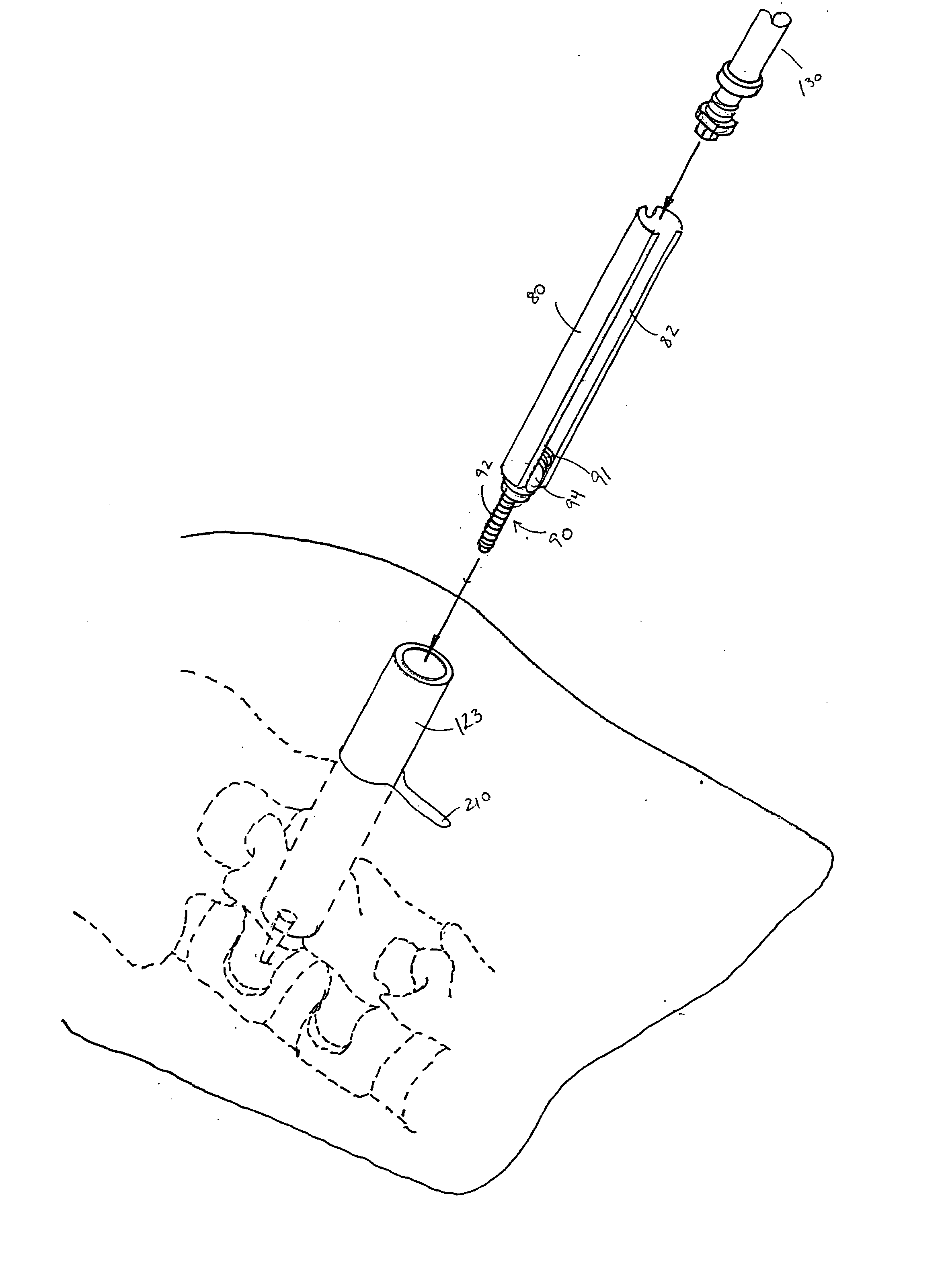 Sleeve assembly for spinal stabilization system and methods of use