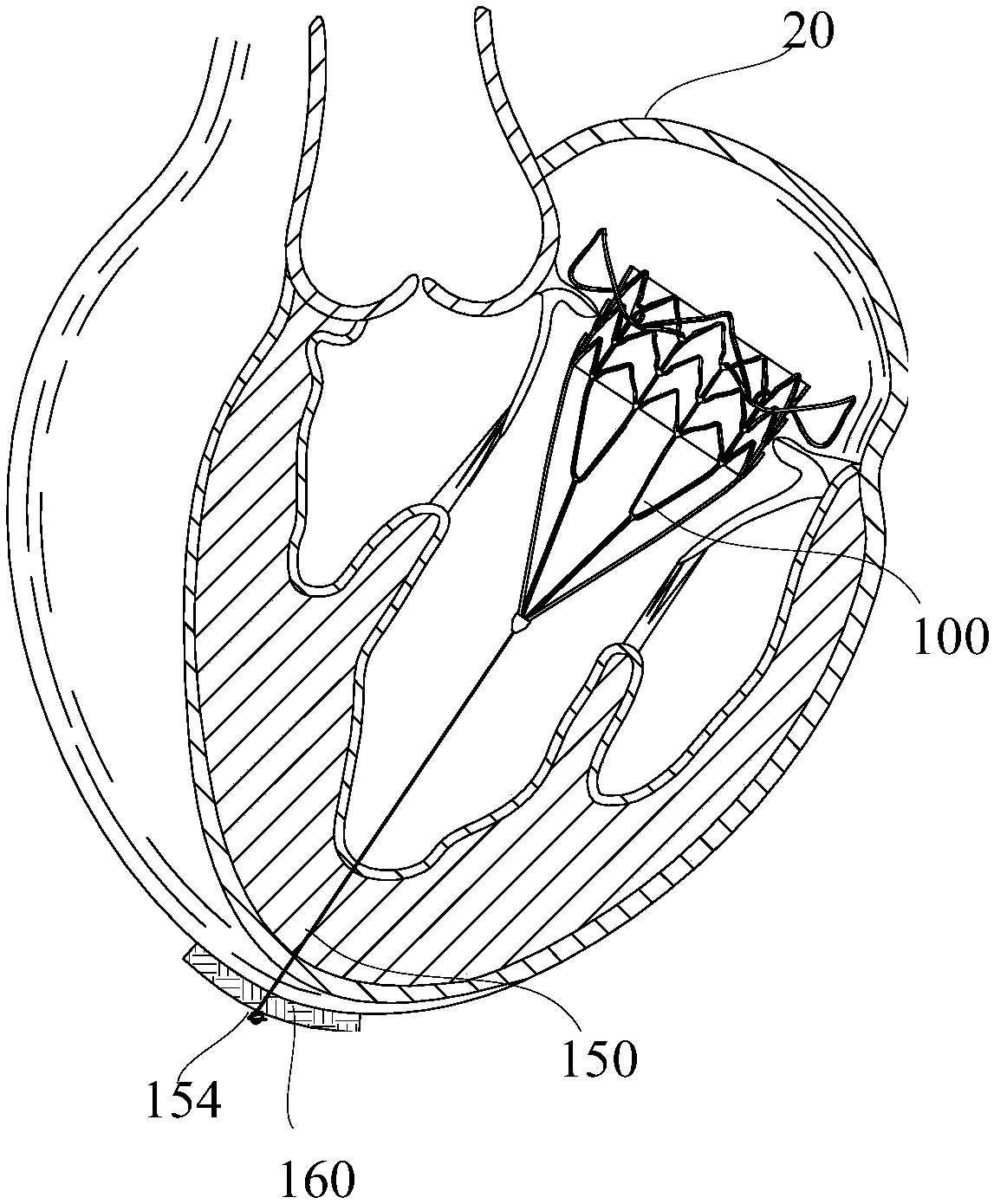 Heart valve