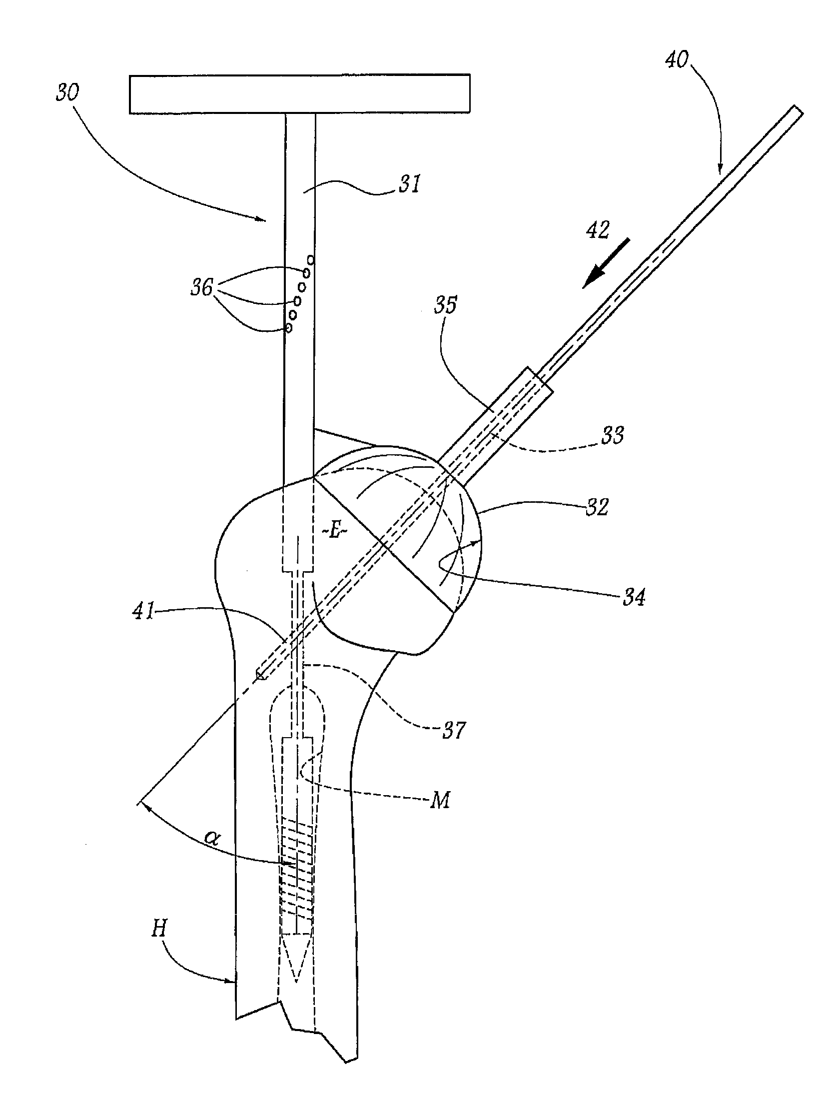 Apparatus for fitting a shoulder prosthesis