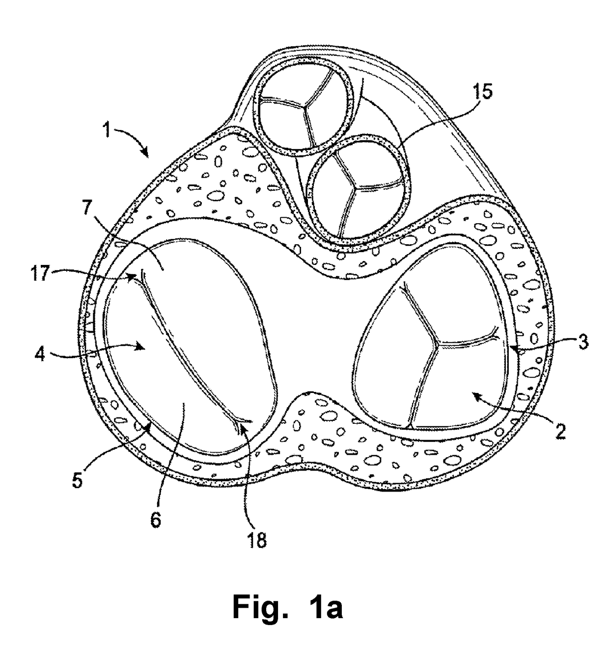 Cardiac valve downsizing device and method