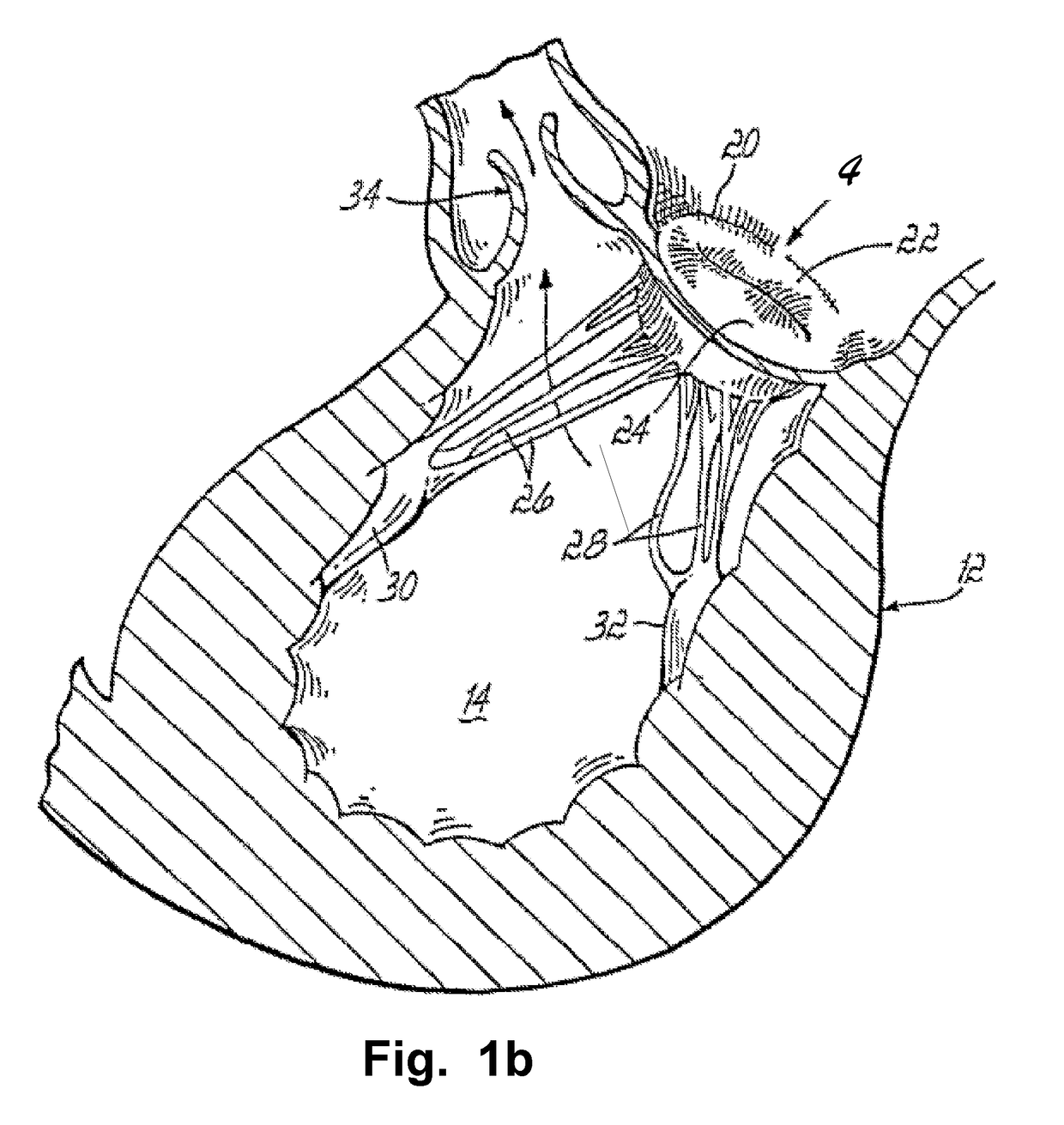 Cardiac valve downsizing device and method