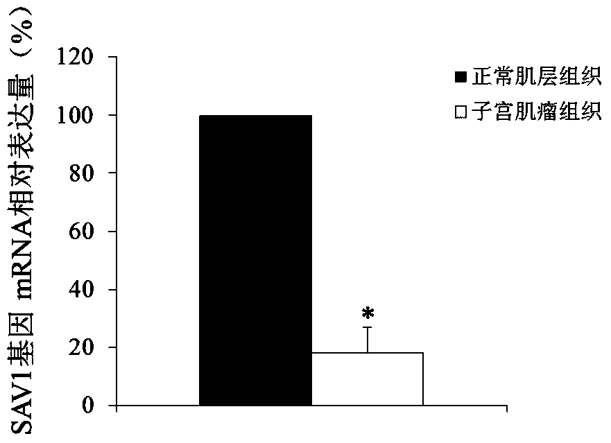 Use of sav1 gene as a marker for diagnosis and treatment of uterine fibroids