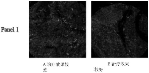 A multiplex immunohistochemical analysis kit for liver cancer and its use and application