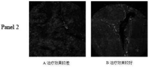 A multiplex immunohistochemical analysis kit for liver cancer and its use and application