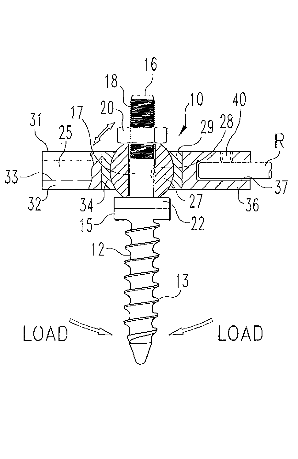 Dynamic Spinal Stabilization System