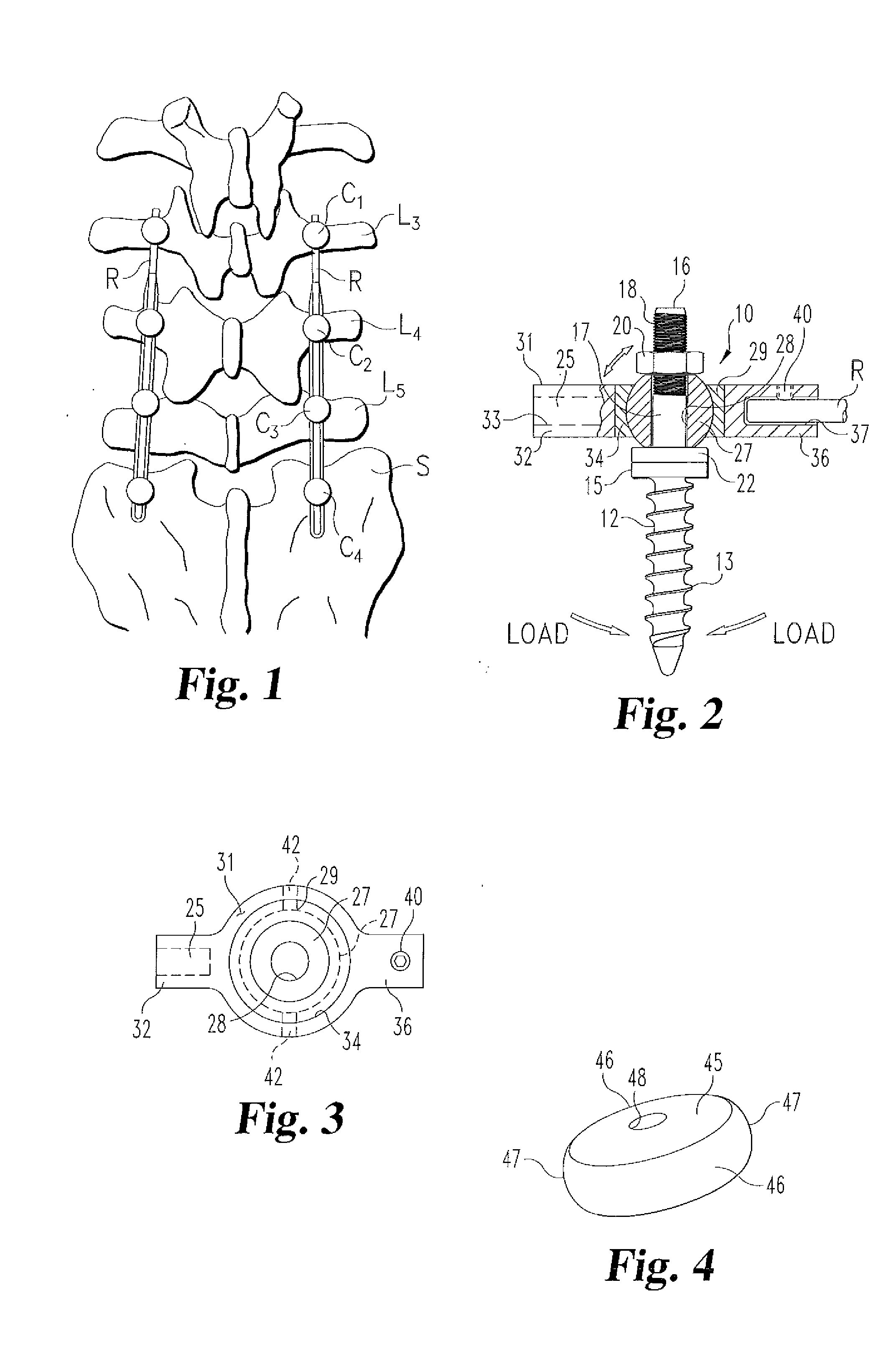 Dynamic Spinal Stabilization System