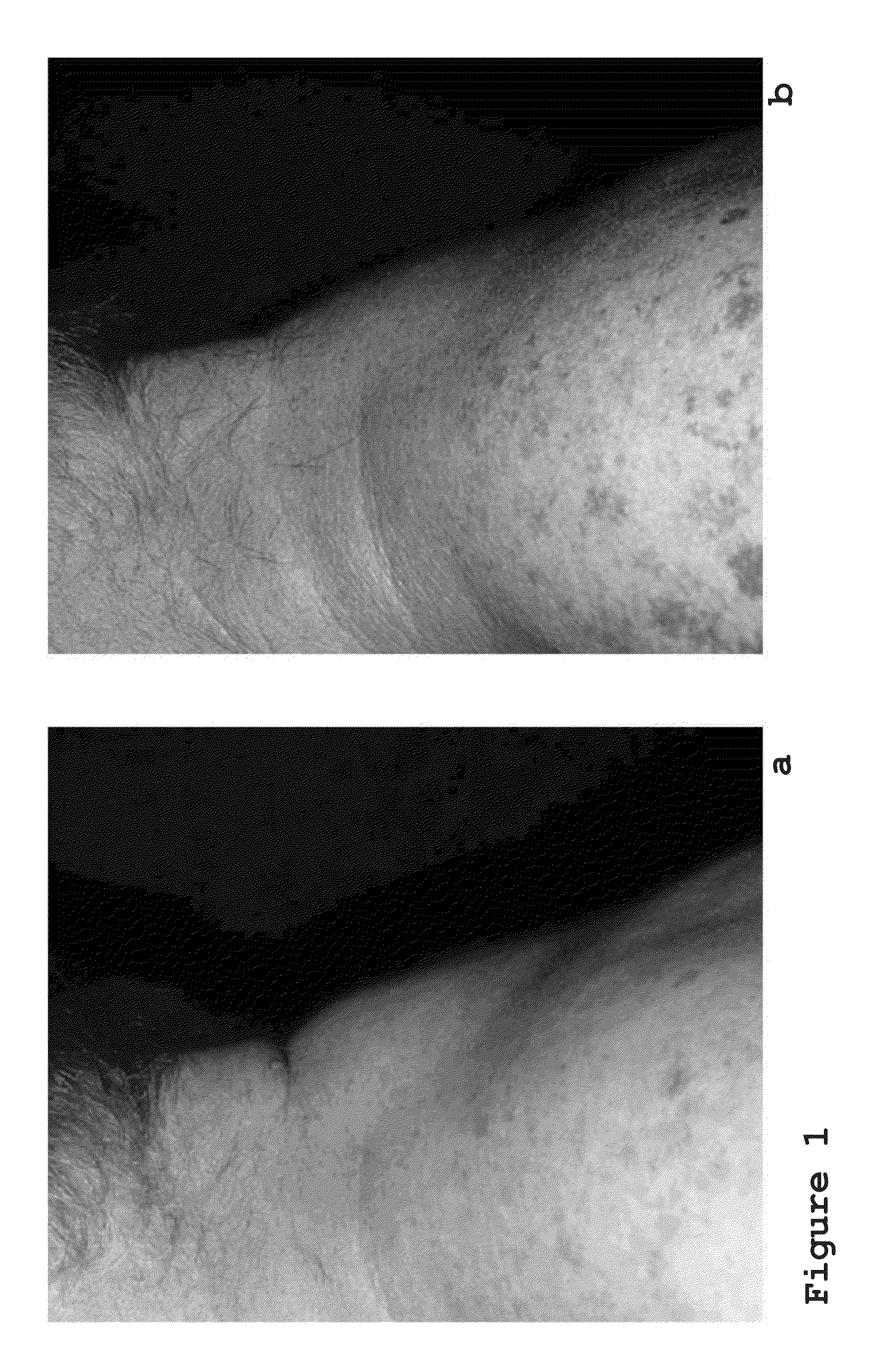 Method for the non-surgical treatment of lipodystrophy in a retrovirus-infected individual