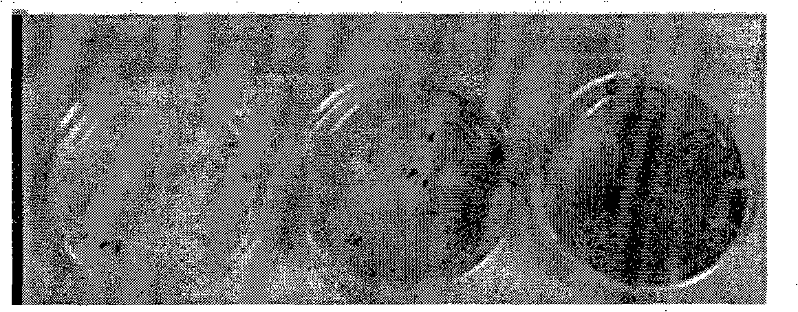 Radionuclide particle implantation medicine for cancer, use and preparation method thereof