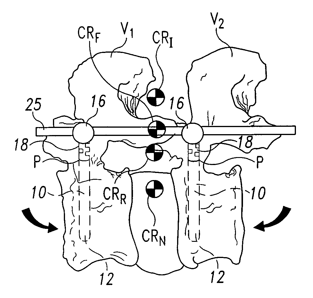 Dynamic spinal stabilization system