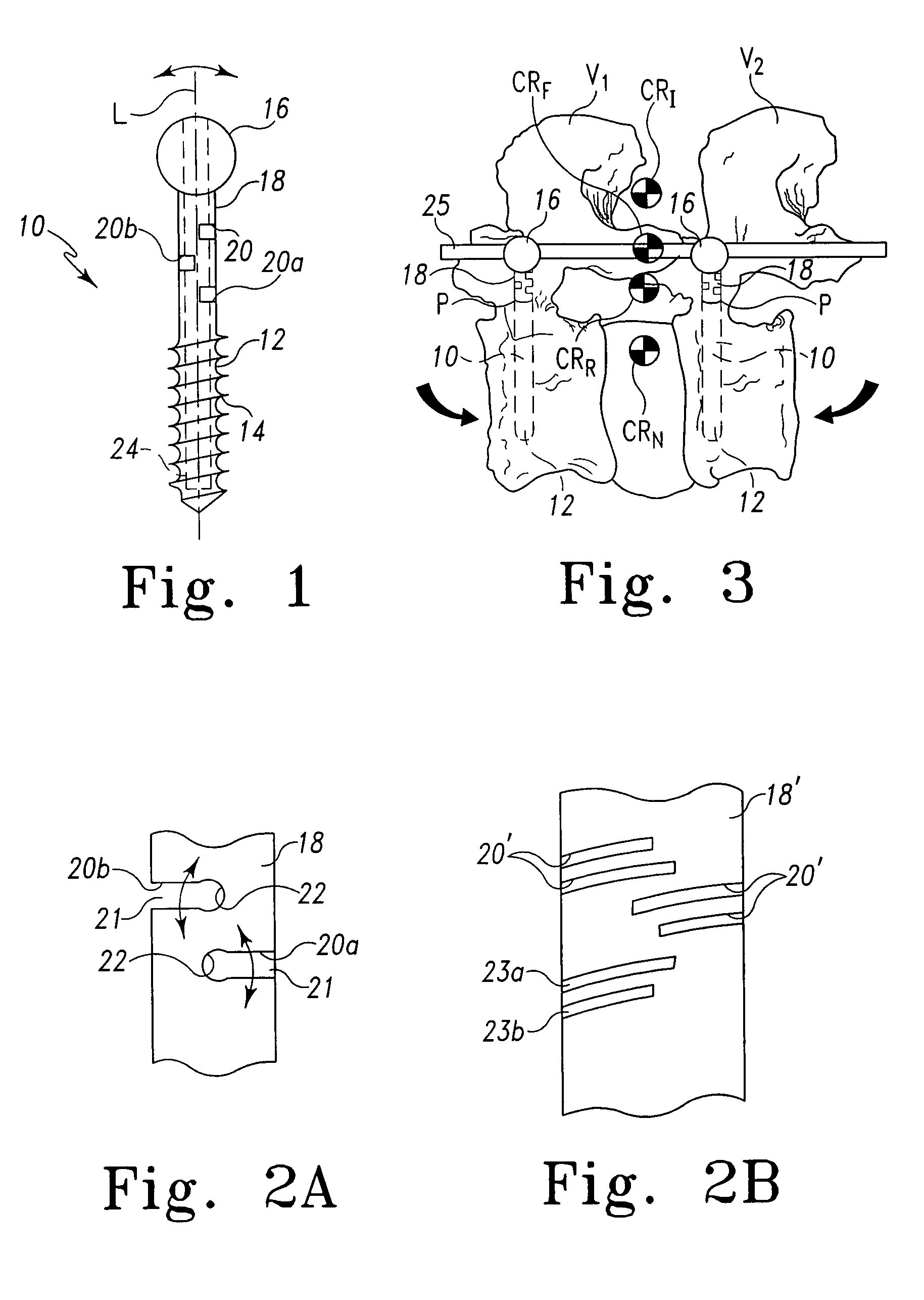 Dynamic spinal stabilization system