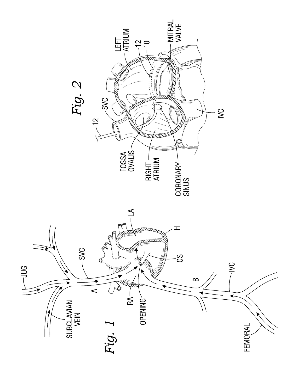 Expandable cardiac shunt