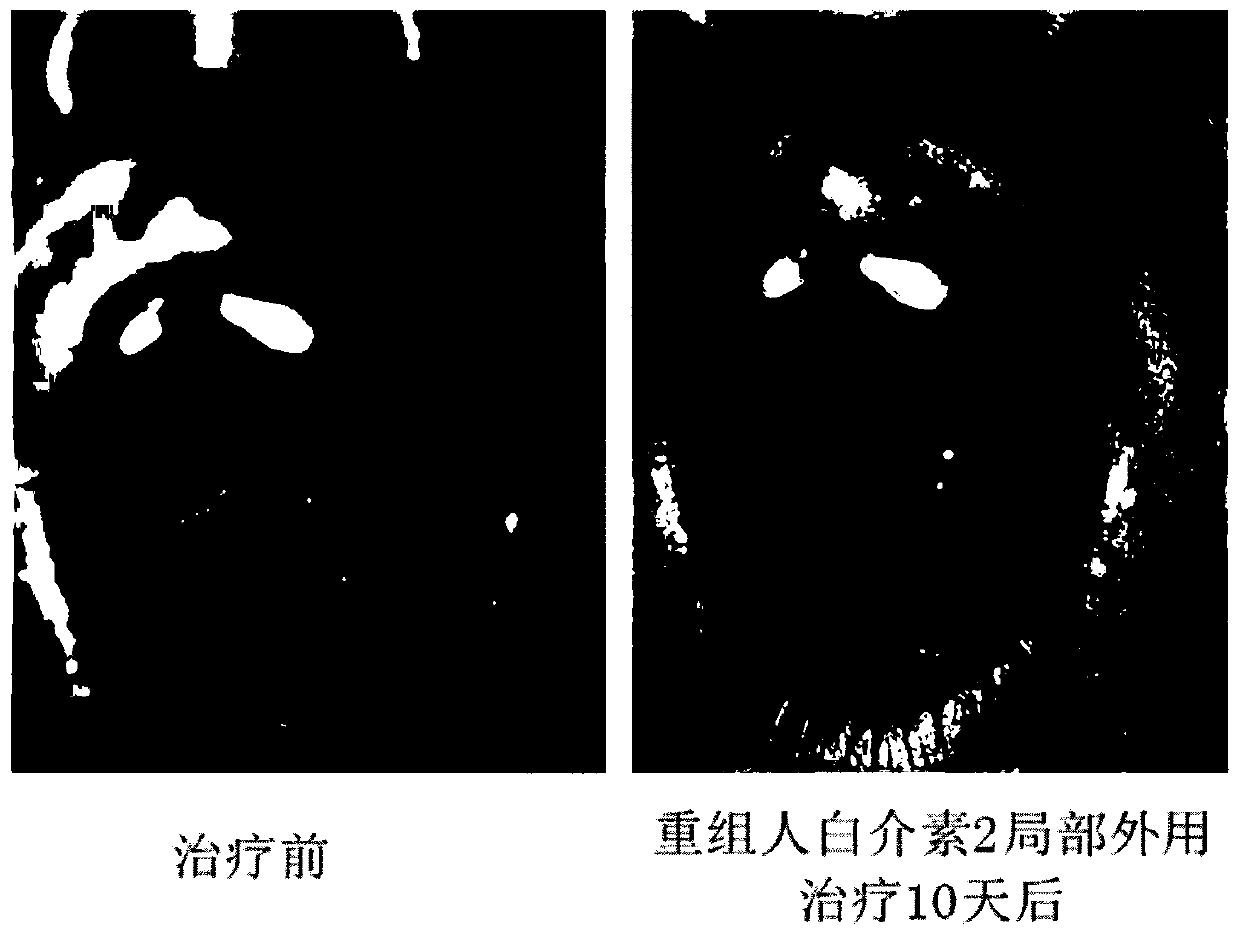 Application of a kind of interleukin 2 in the preparation of a medicine for treating pemphigus vulgaris oral erosion