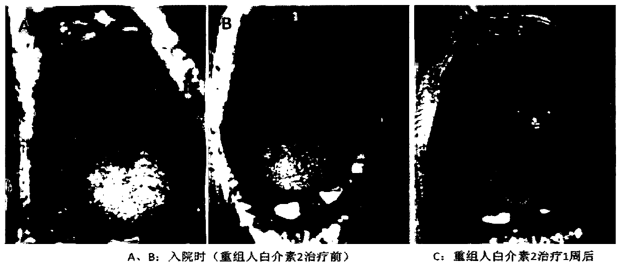 Application of a kind of interleukin 2 in the preparation of a medicine for treating pemphigus vulgaris oral erosion