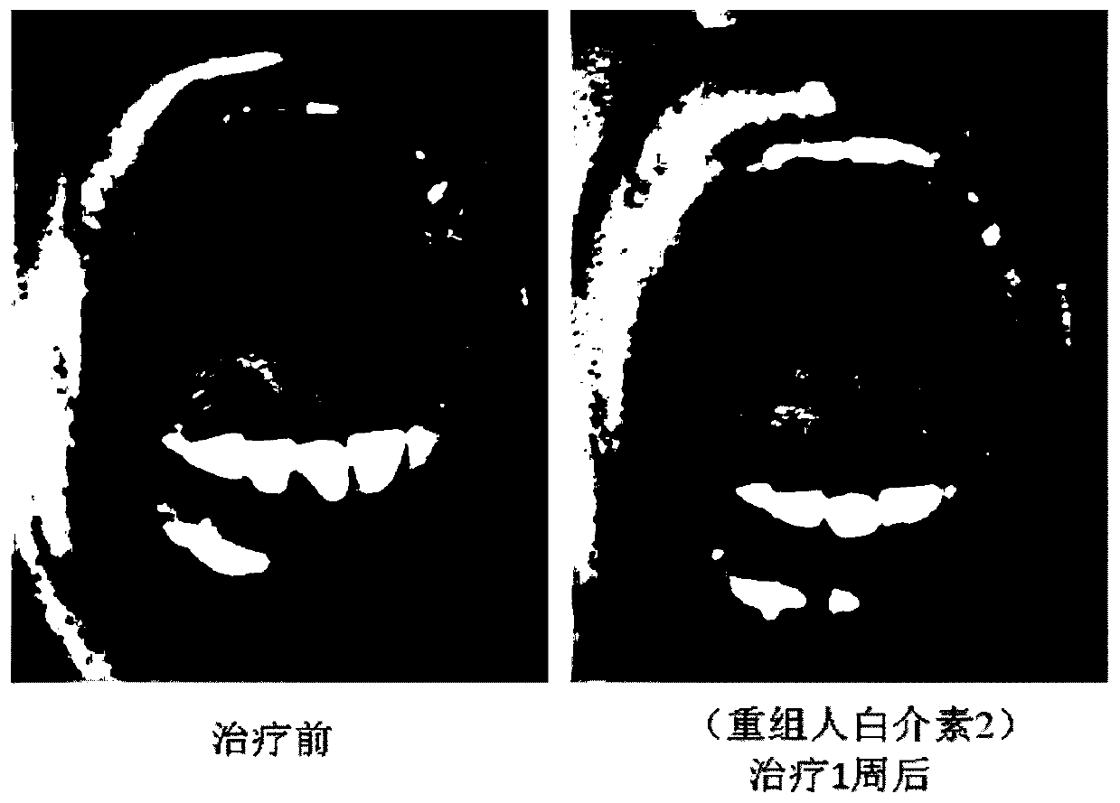 Application of a kind of interleukin 2 in the preparation of a medicine for treating pemphigus vulgaris oral erosion