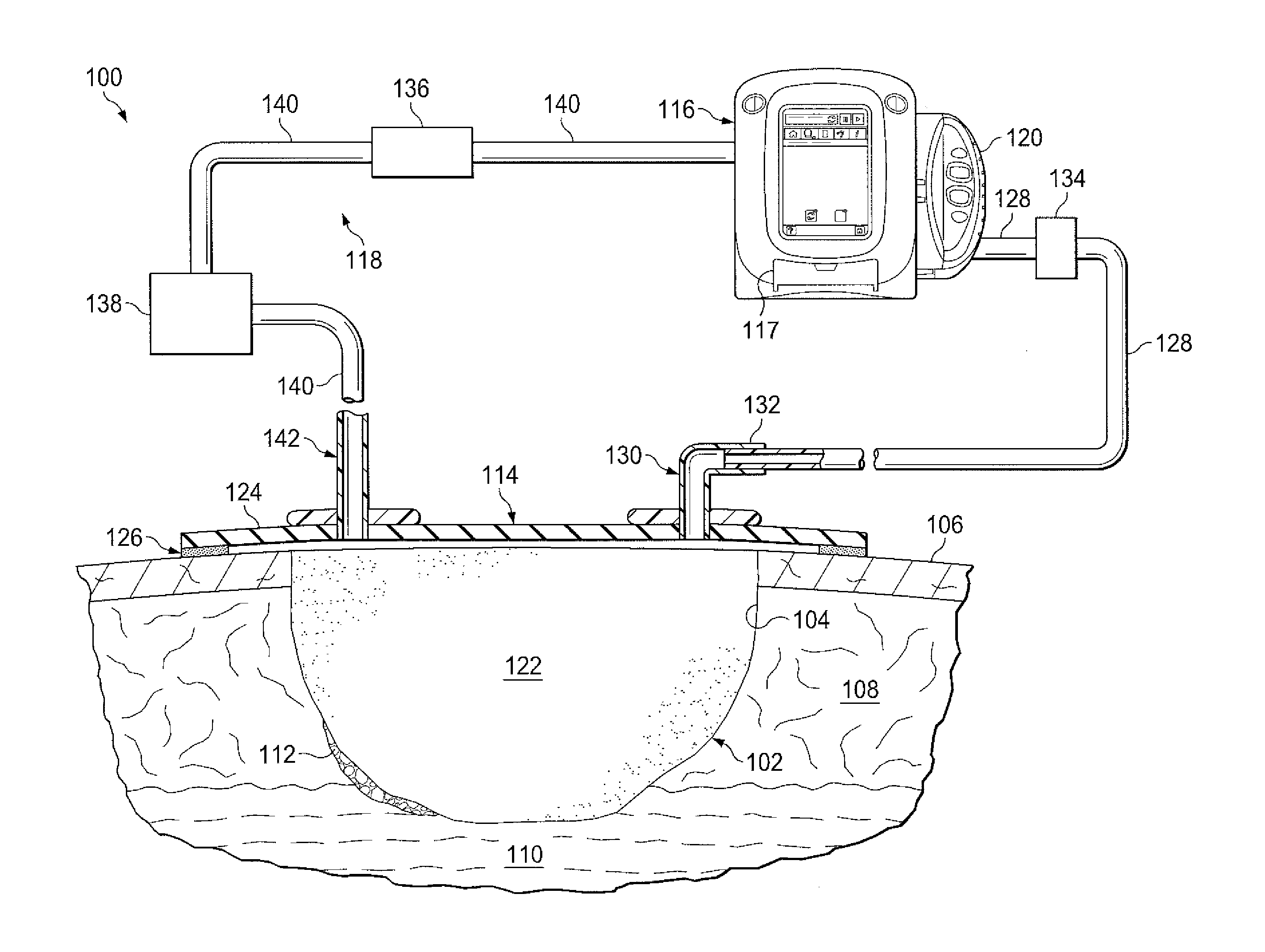 Wound debridement by irrigation with ultrasonically activated microbubbles