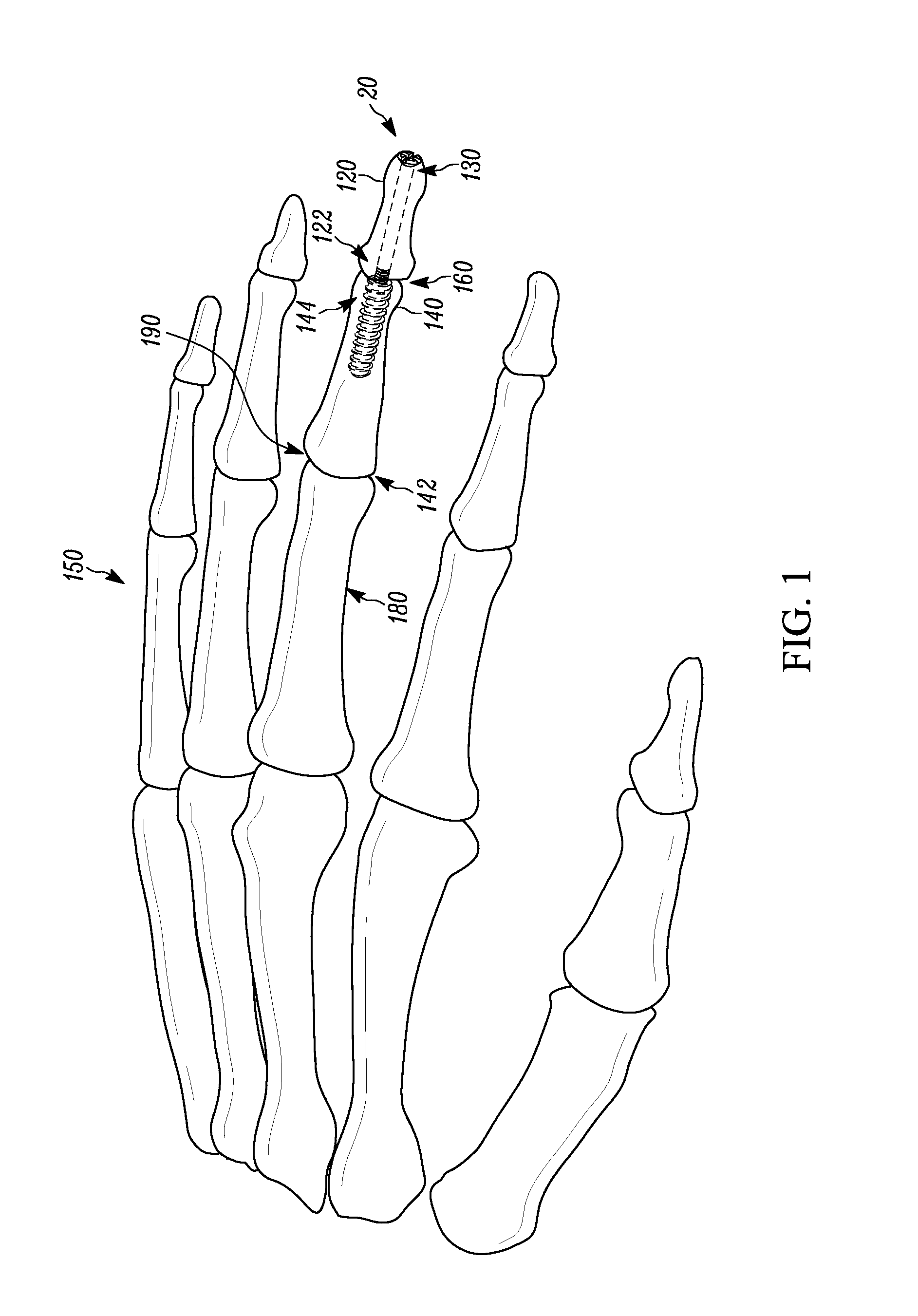 Arthrodesis device and method of use