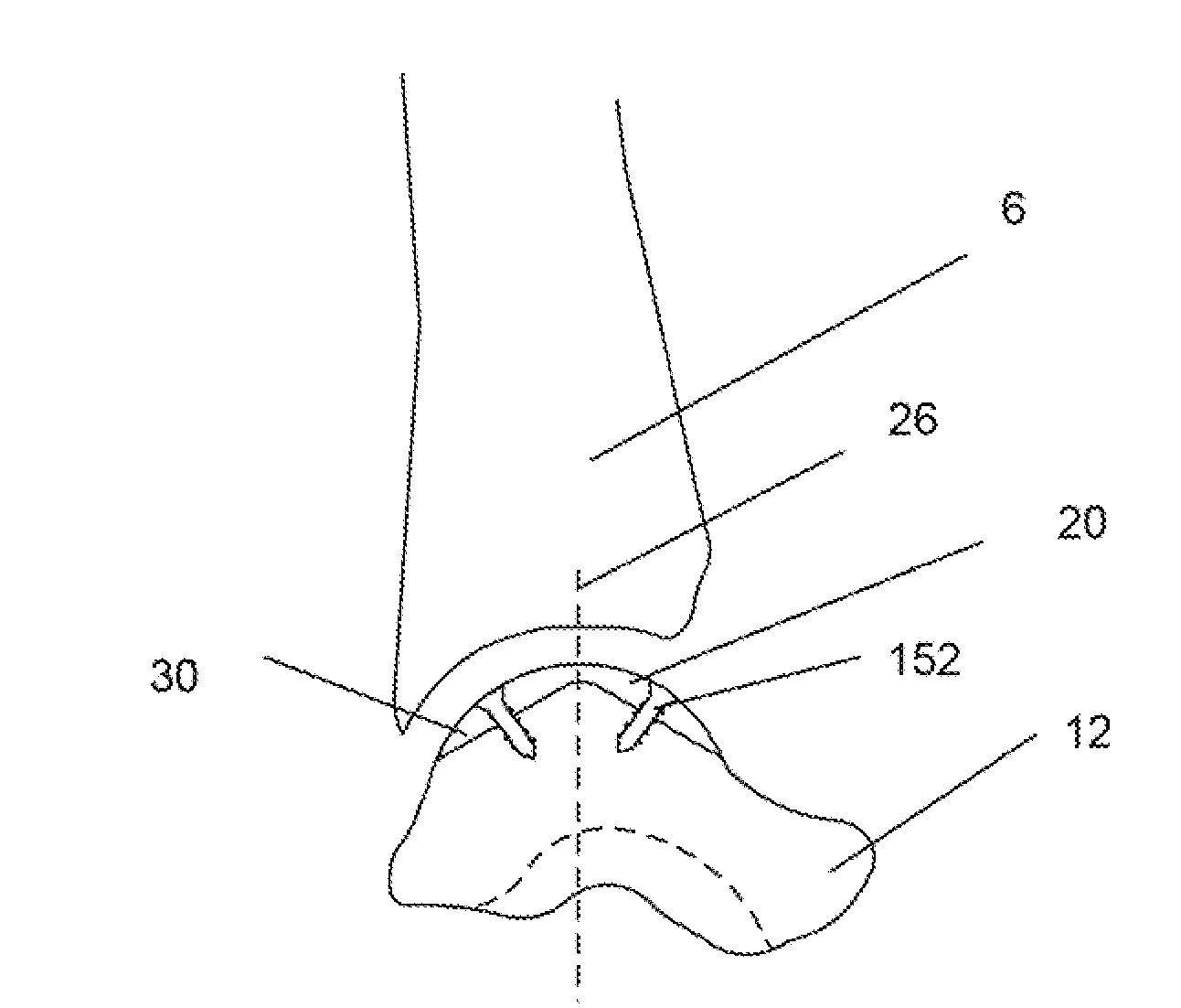 Bone prosthesis