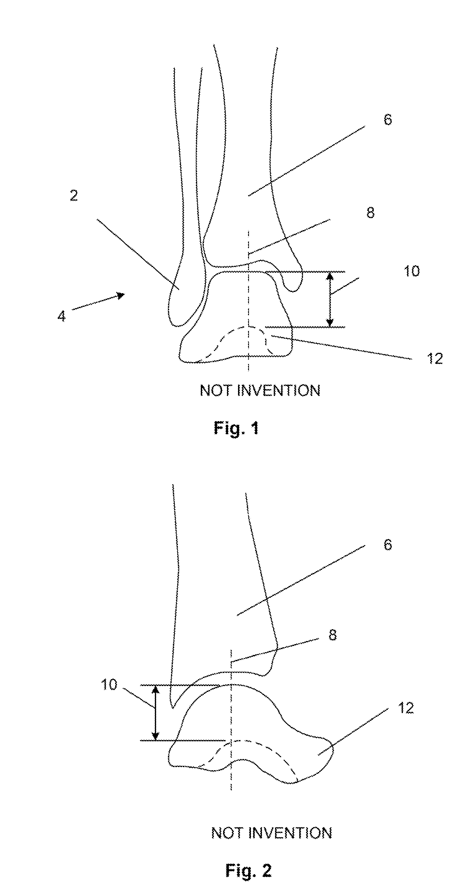 Bone prosthesis