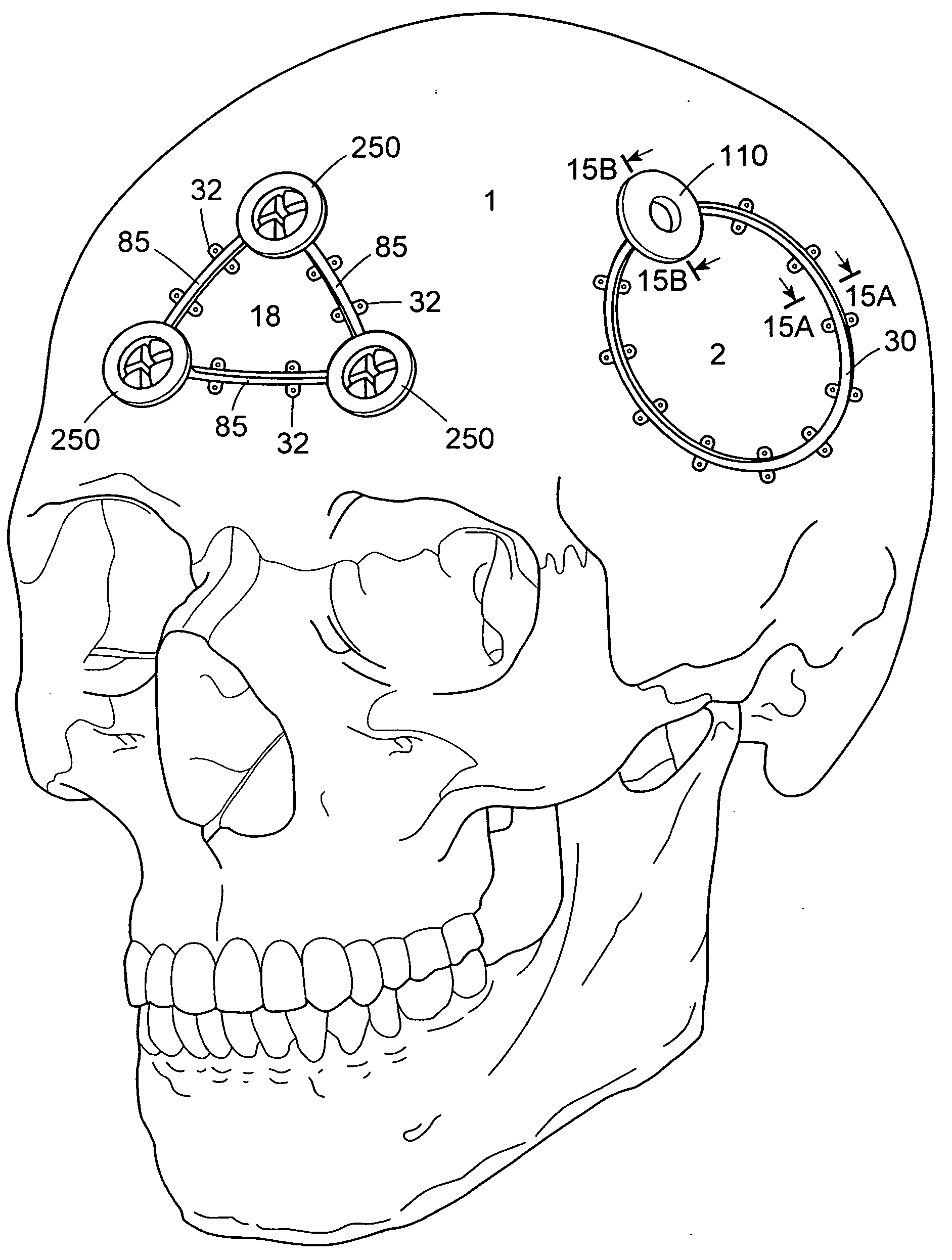 Craniotomy closures and plugs