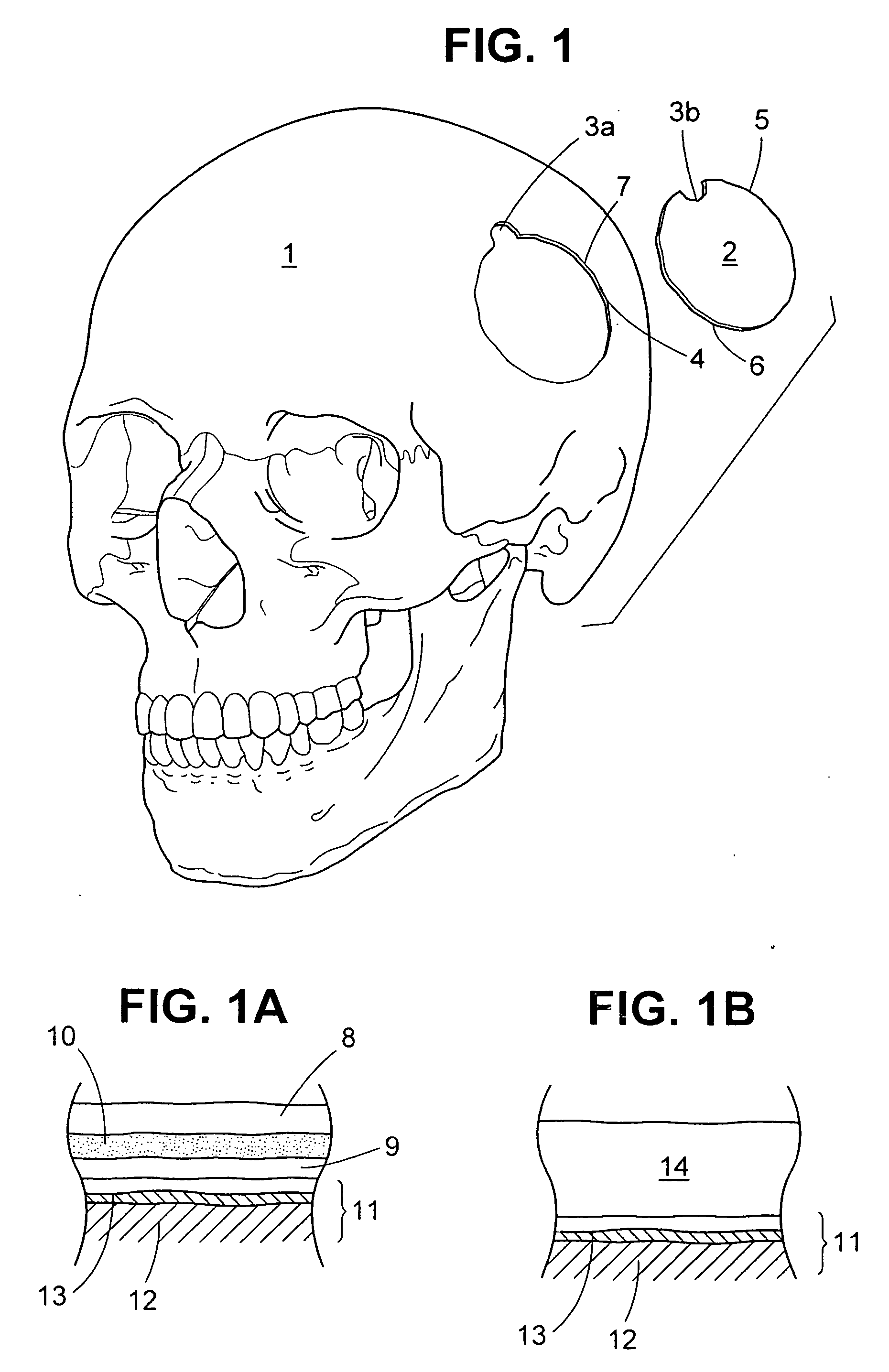 Craniotomy closures and plugs