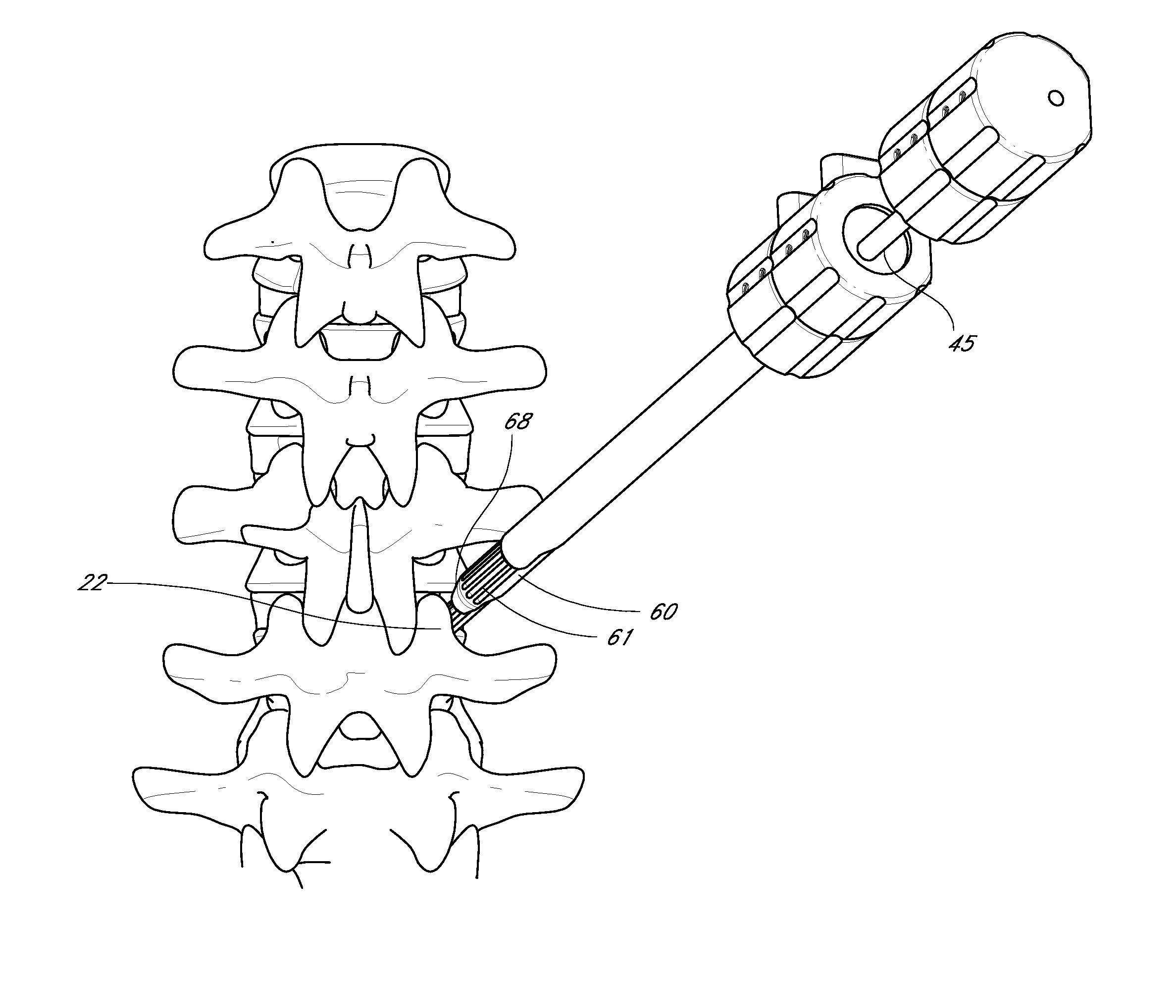 Method and apparatus for minimally invasive insertion of intervertebral implants