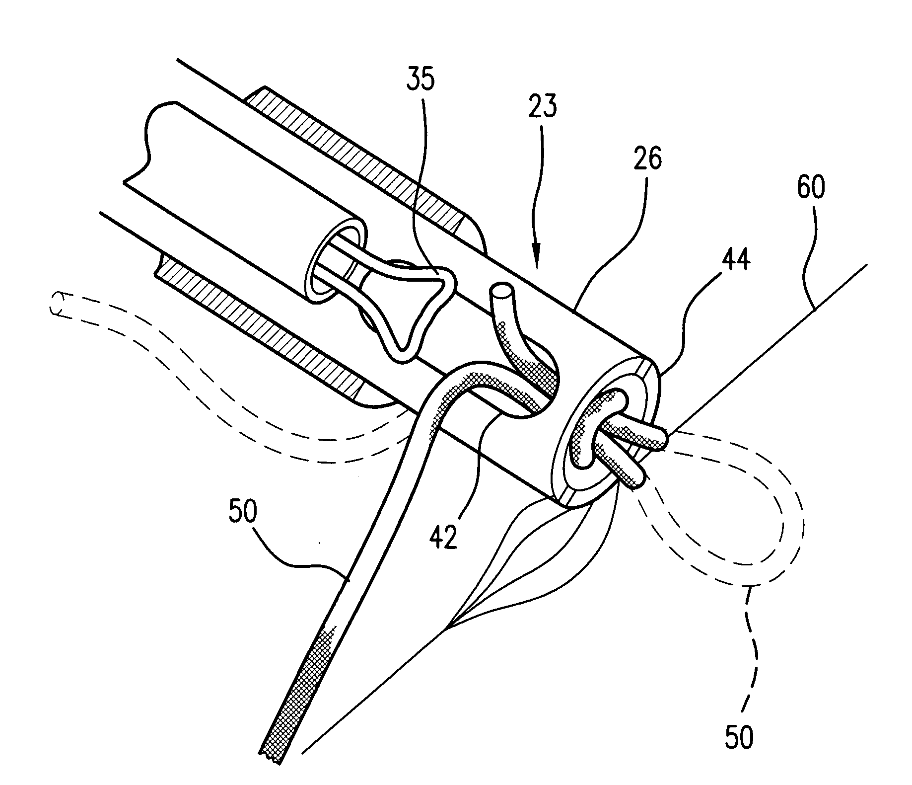 Suturing device and technique