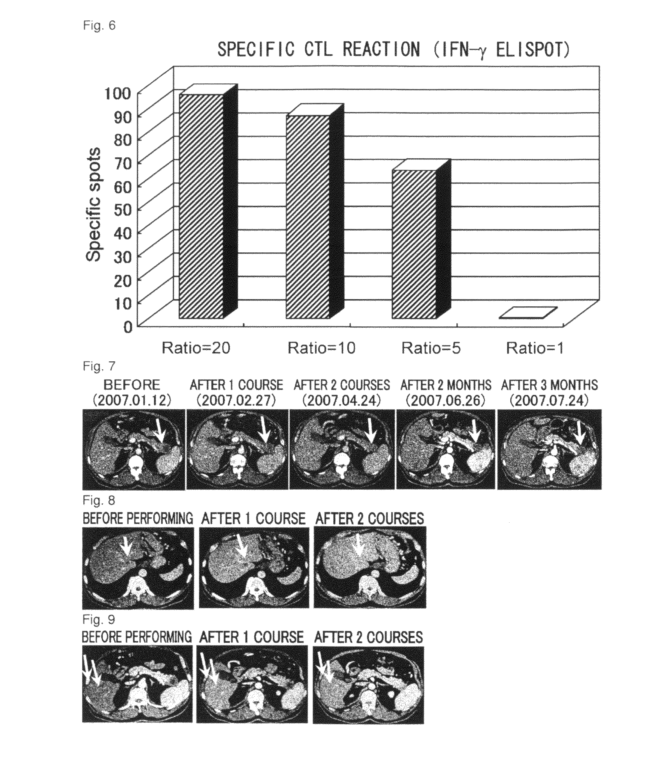 Combination therapy for pancreatic cancer using an antigenic peptide and chemotherapeutic agent