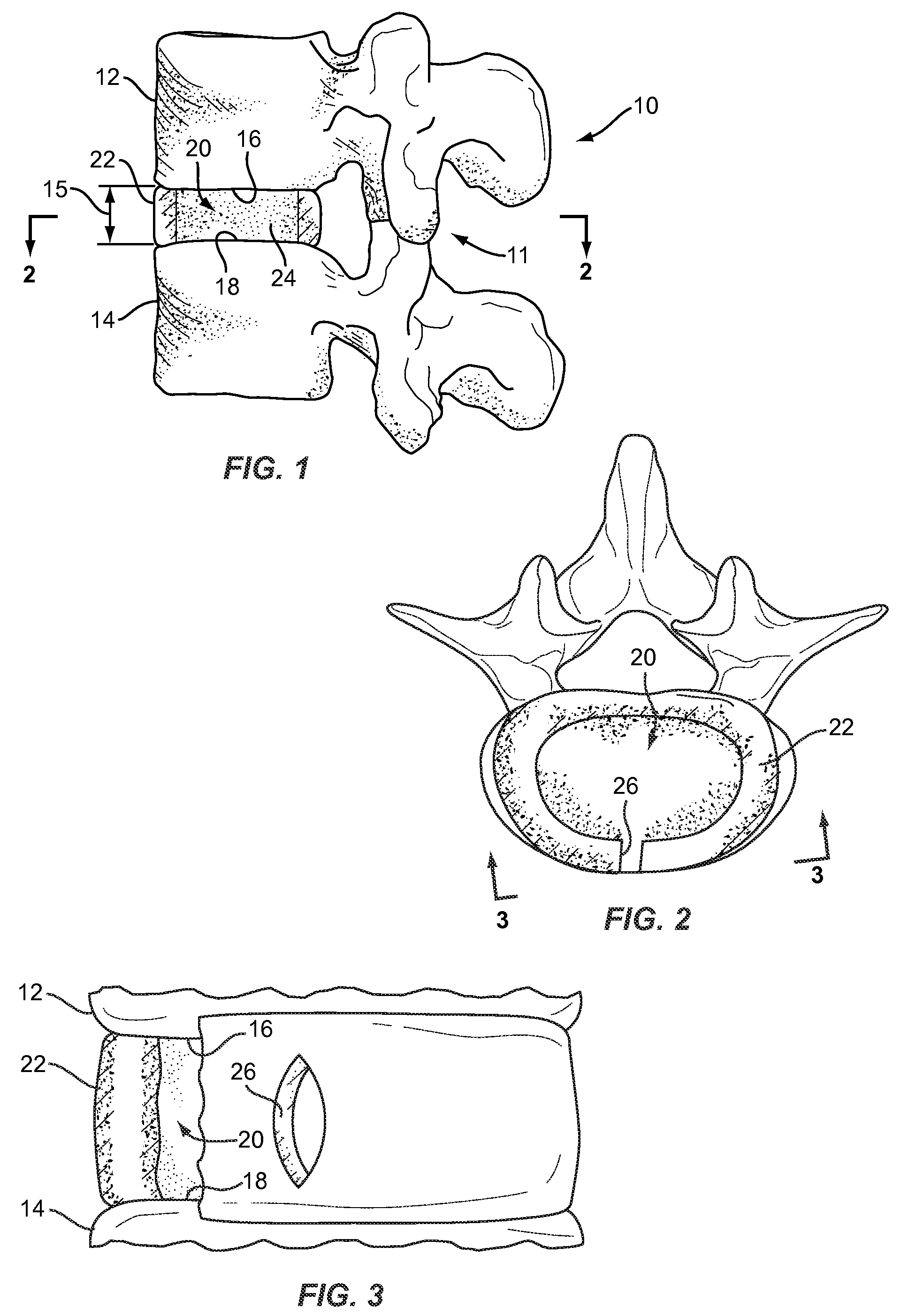 Spinal nucleus replacement implants