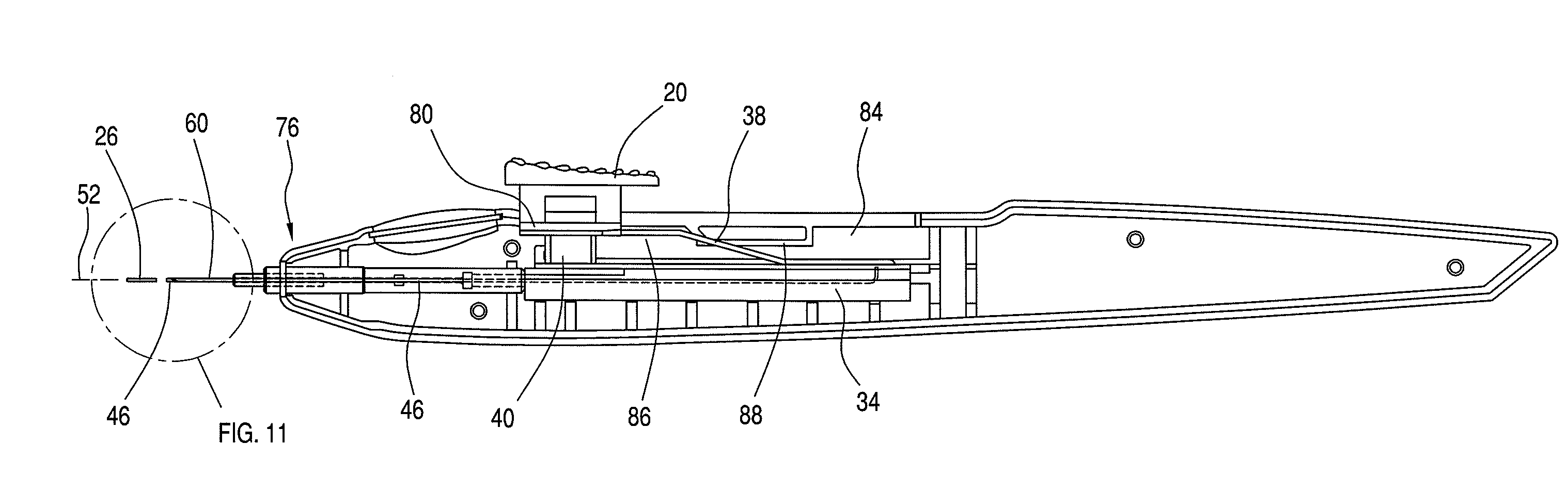 Ocular Implantation Device