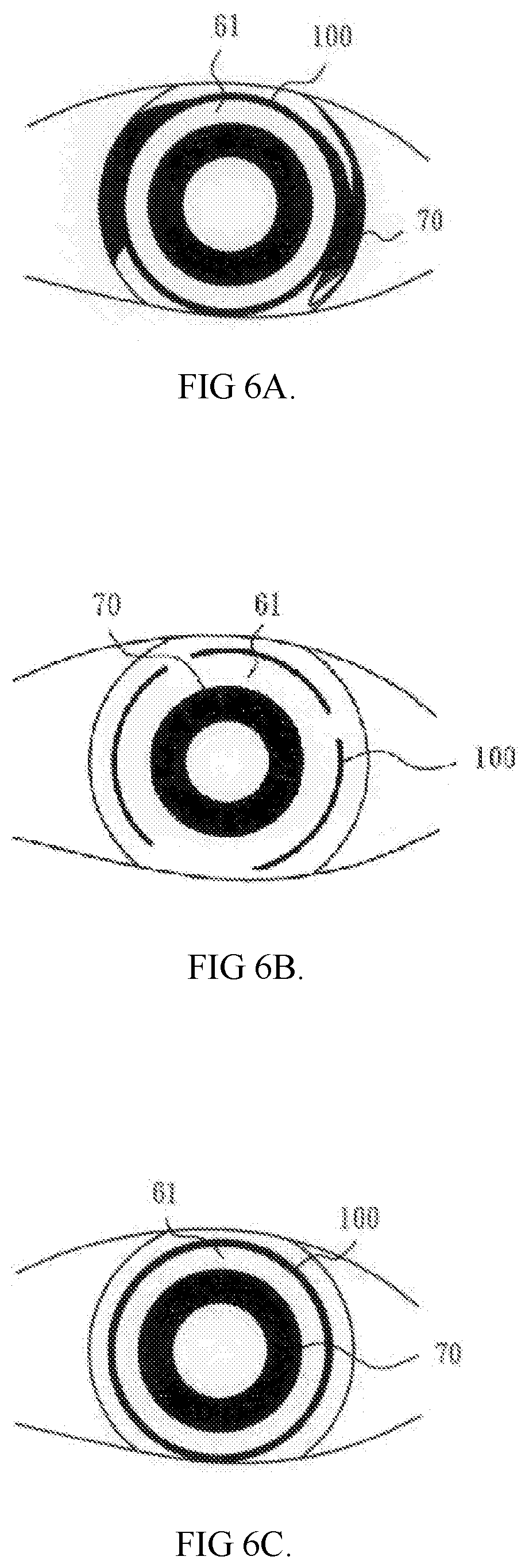 Suction pump orthokeratology lens