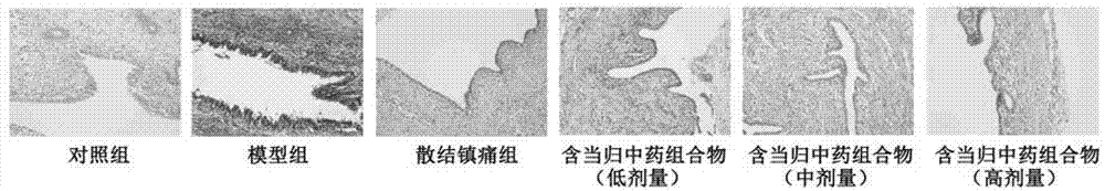 Traditional Chinese medicine composite containing angelica sinensis and having function of treating endometriosis